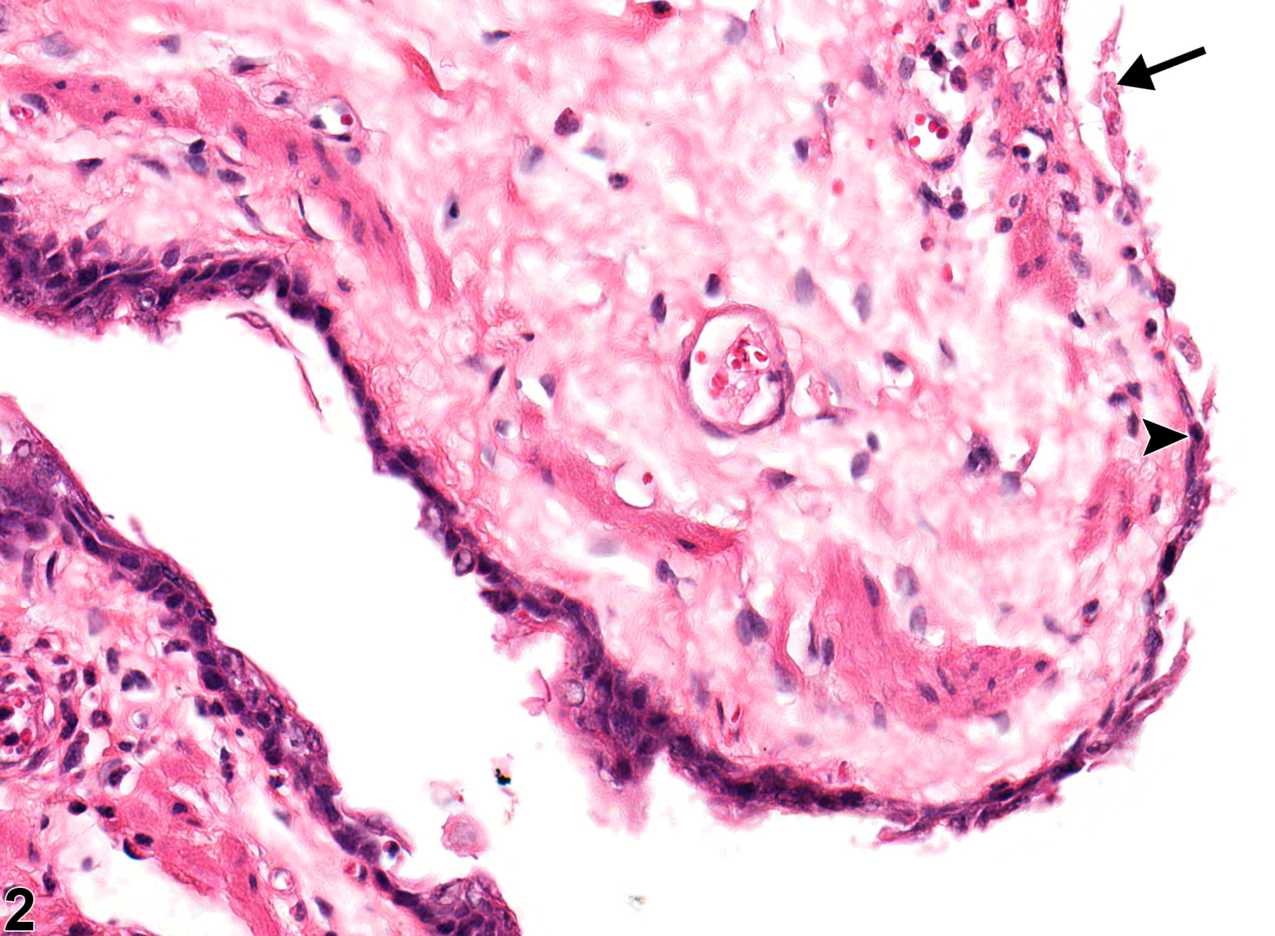 Image of ulcer in the esophagus from a female F344/N rat in a chronic study