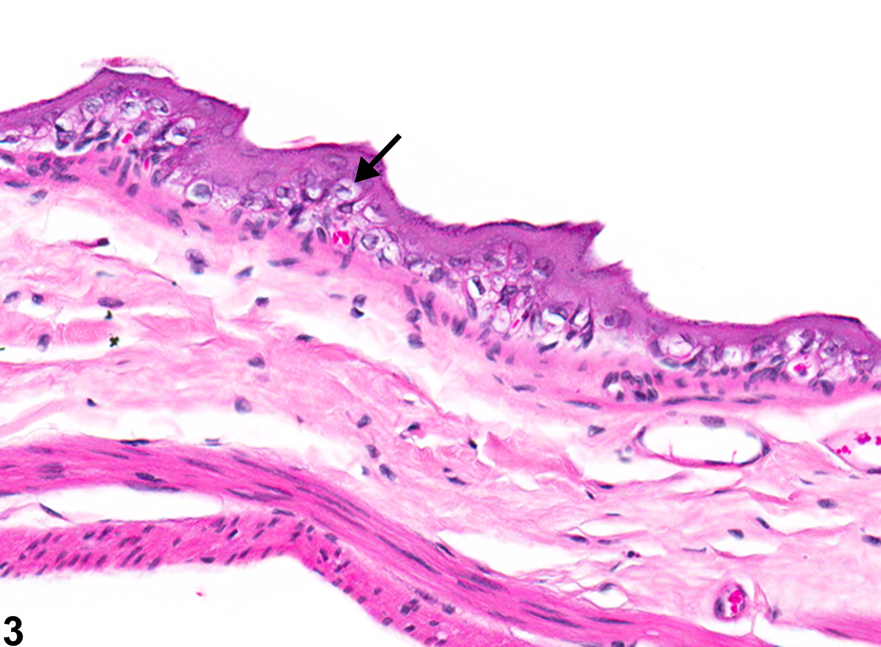 Image of degeneration in the forestomach epithelium from a male B6C3F1 mouse in a chronic study