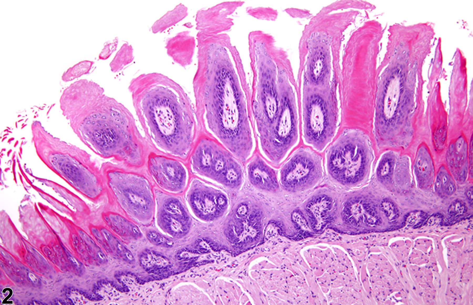 Image of hyperplasia (focal, diffuse) in the forestomach epithelium from a female F344/N rat in a chronic study