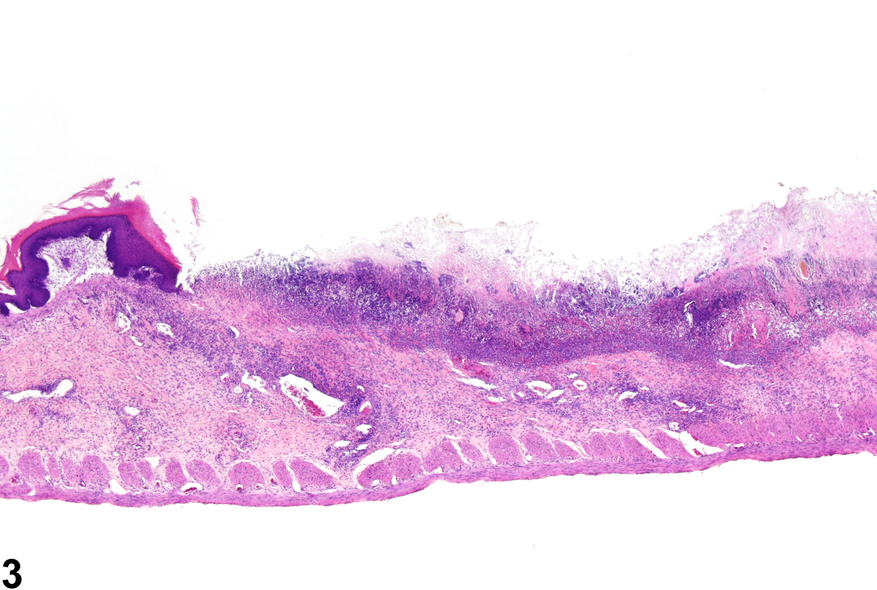 Image of ulcer in the forestomach from a male F344/N rat in a chronic study