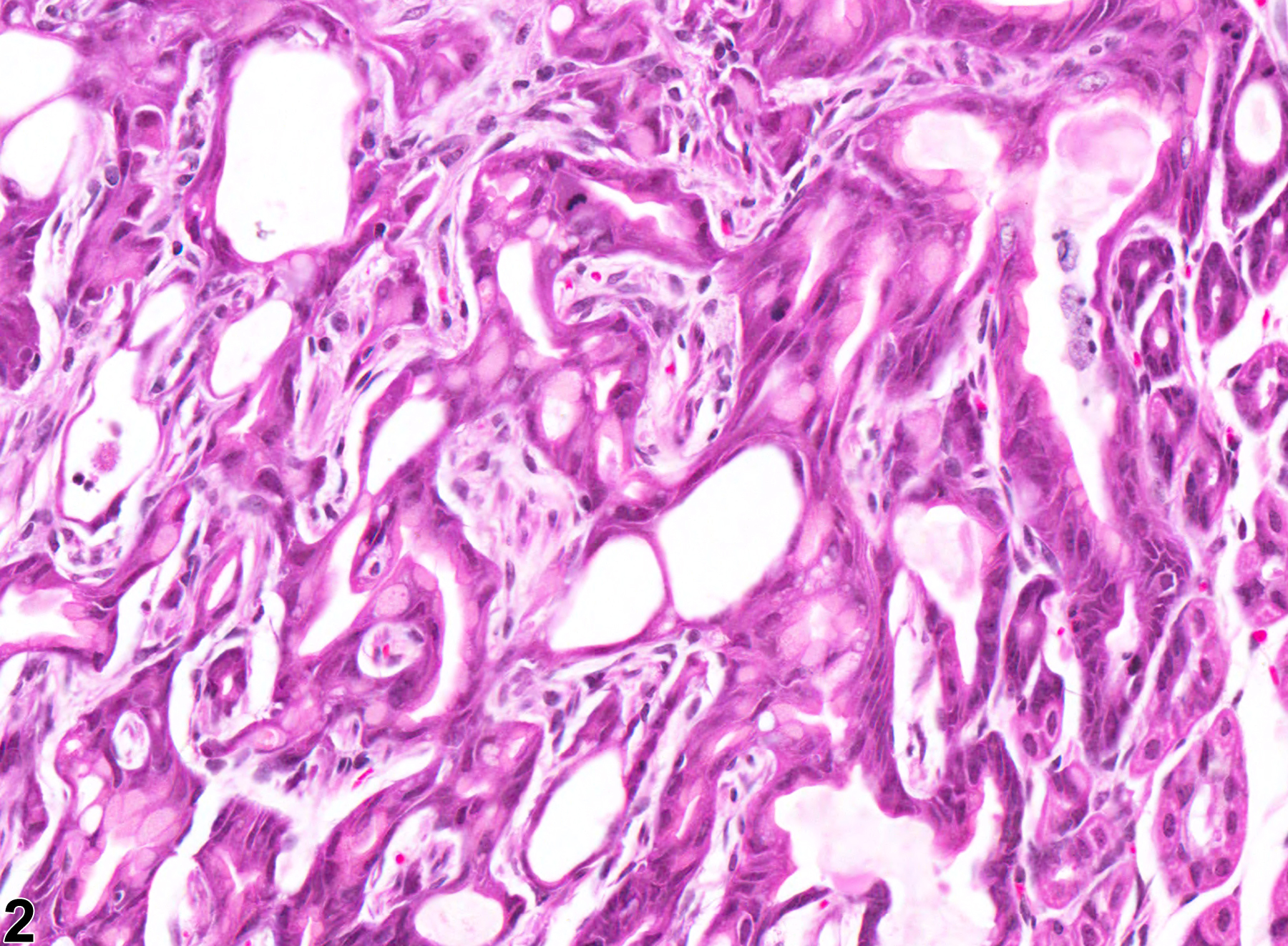 Image of hyperplasia, atypical in the glandular stomach epithelium from a female B6C3F1 mouse in a chronic study