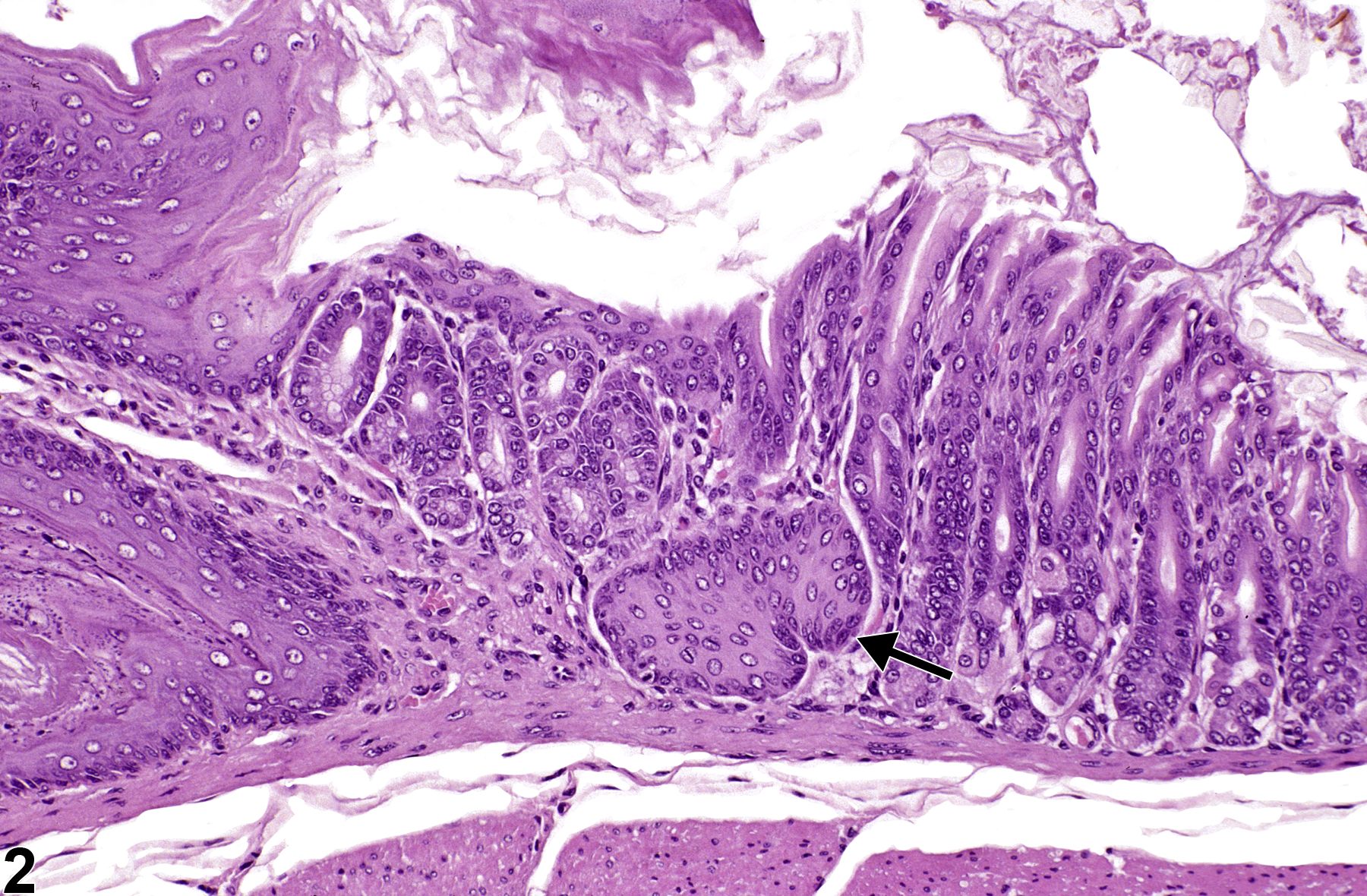 Image of metaplasia, squamous in the glandular stomach from a male B6C3F1 mouse in a chronic study