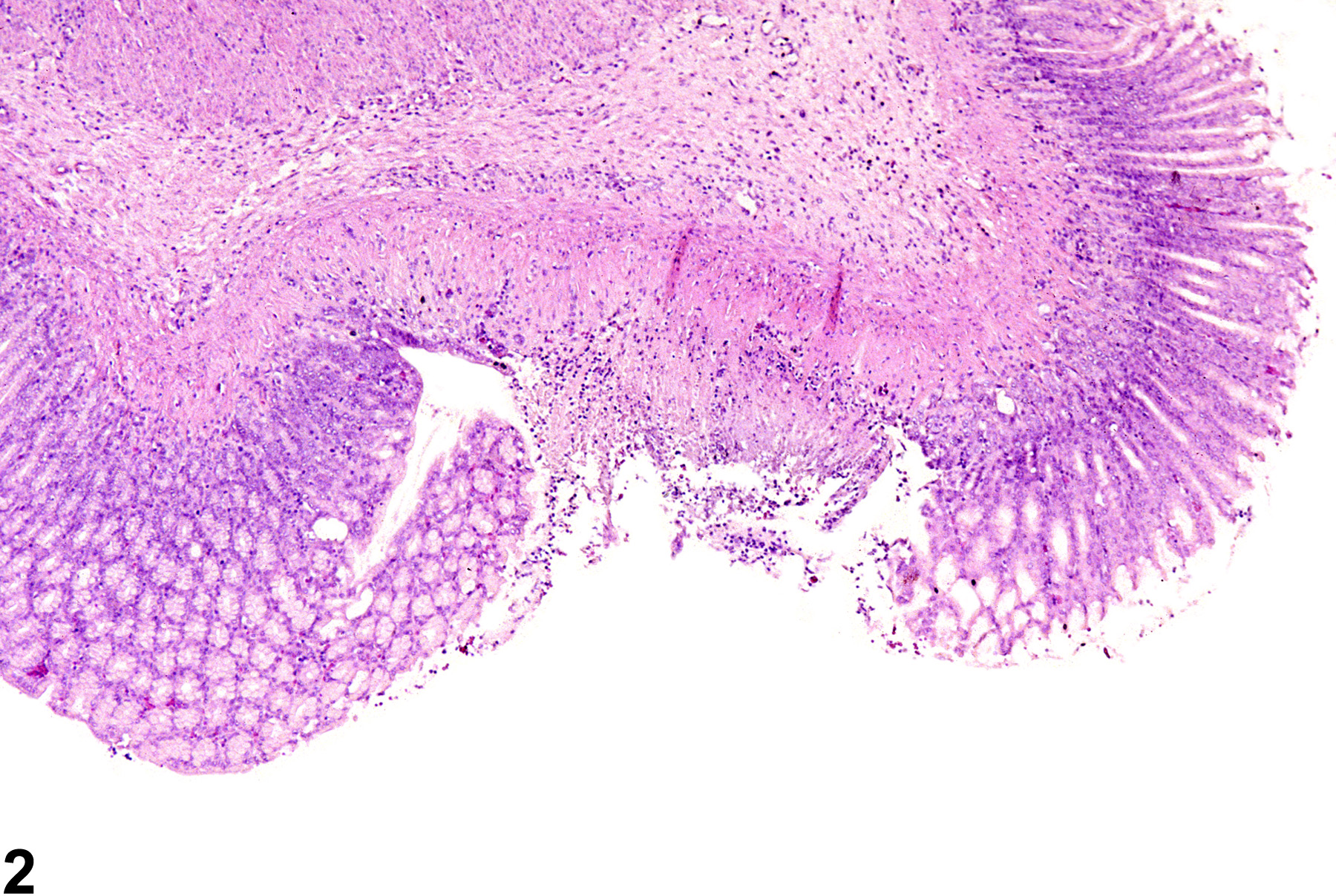 Image of ulcer in the glandular stomach from a male F344/N rat in a chronic study
