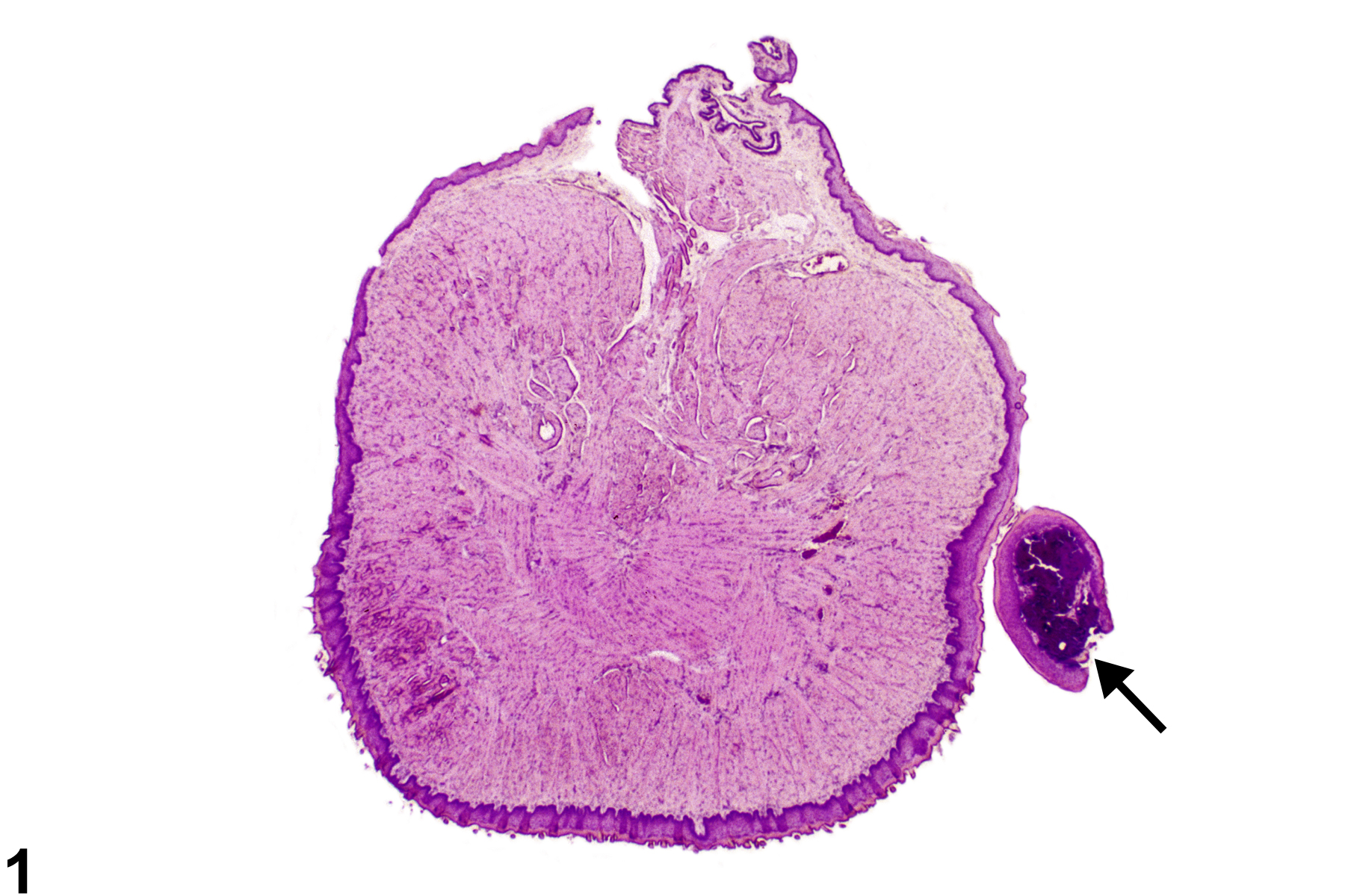 Image of fibroepithelial polyp in the tongue mucosa from a male B6C3F1 mouse in a chronic study