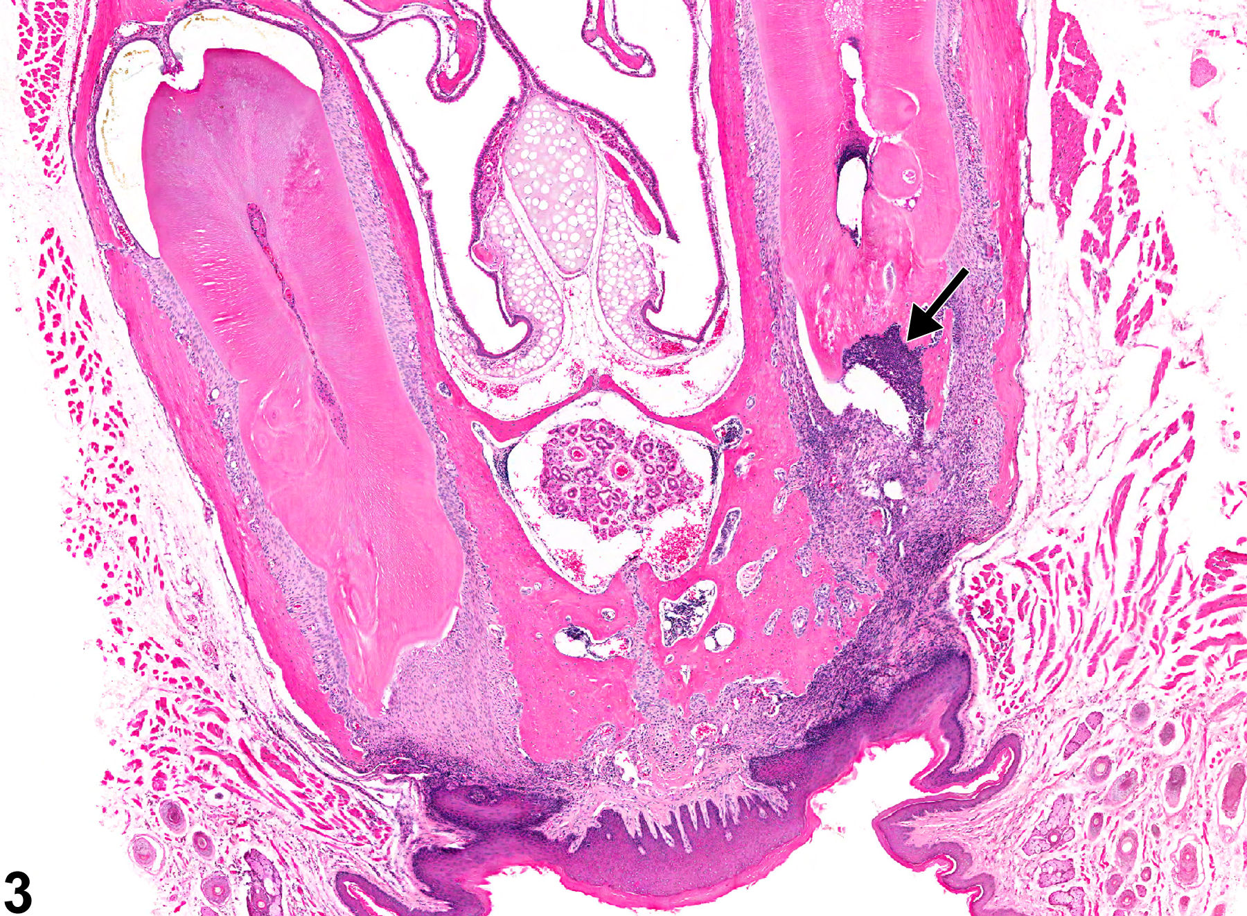 Image of inflammation in the tooth from a male B6C3F1 mouse in a chronic study