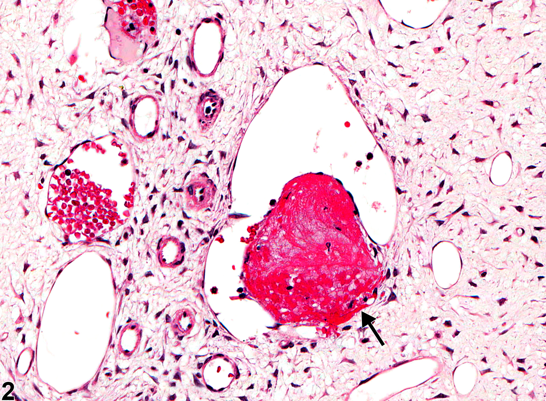 Image of thrombus in the tooth pulp from a female F344/N rat in a subchronic study