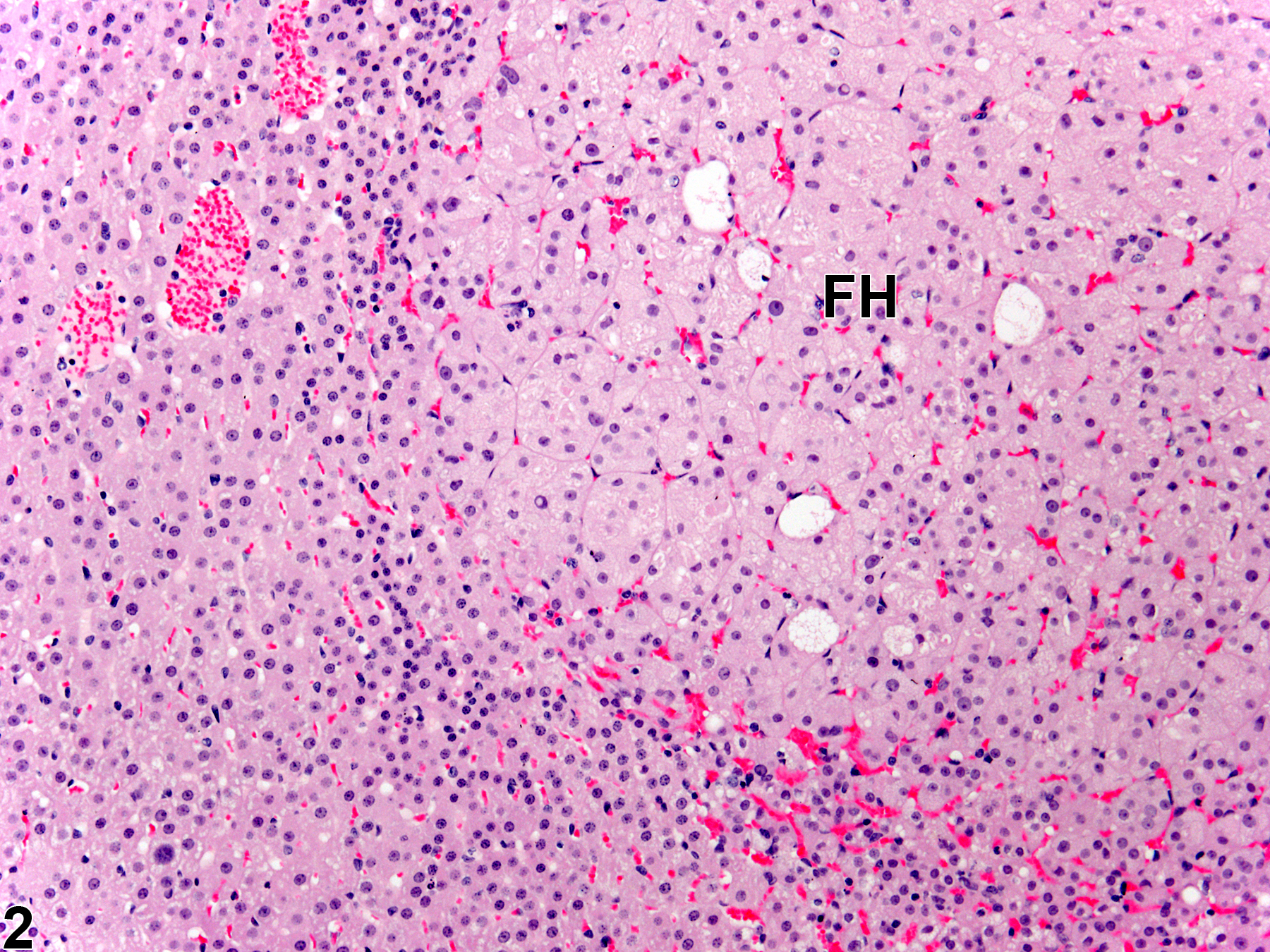 Image of hypertrophy in the adrenal gland cortex from a female Sprague-Dawley rat in a chronic study