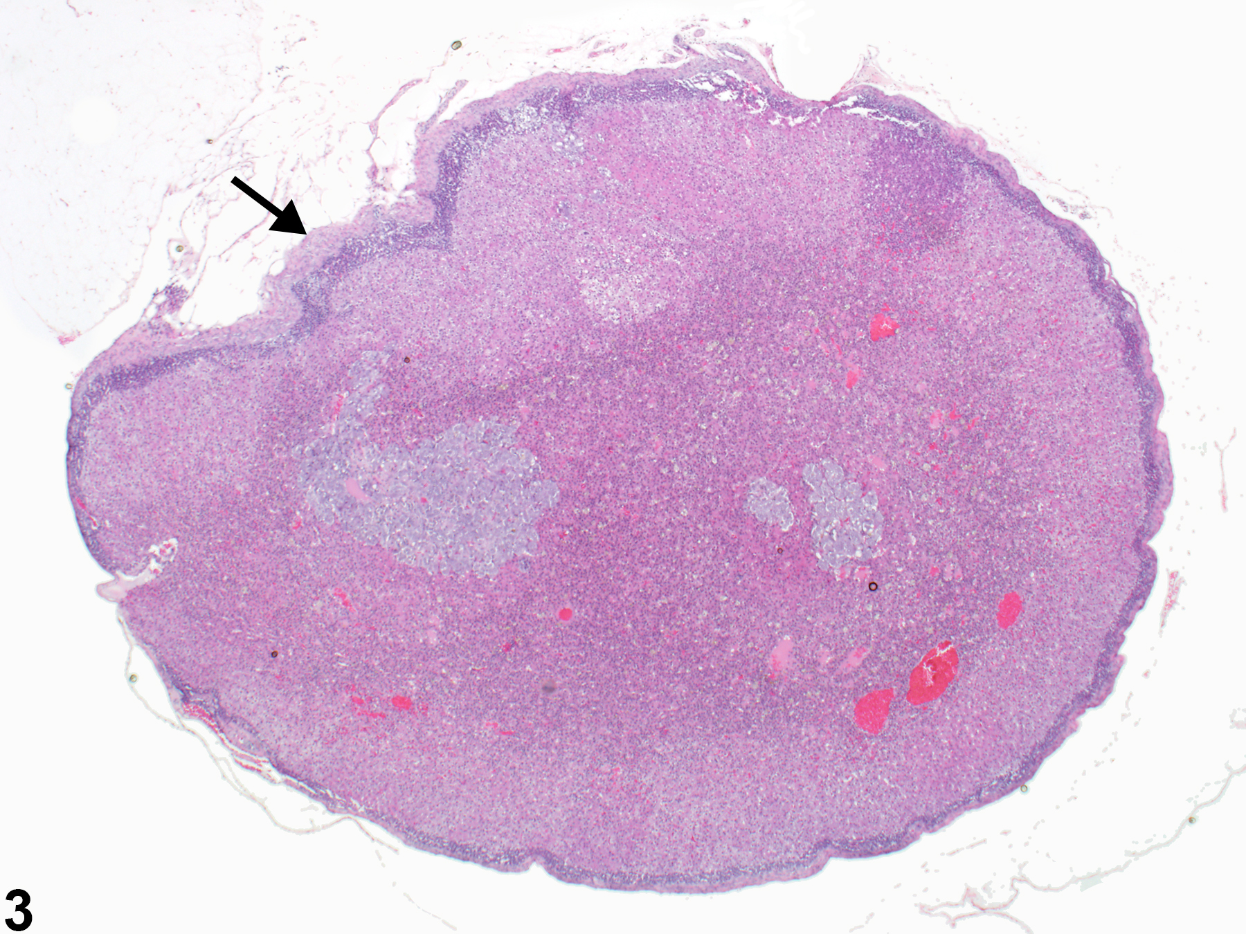 Image of fibrosis in the adrenal gland capsule from a female F344/N rat in a chronic study