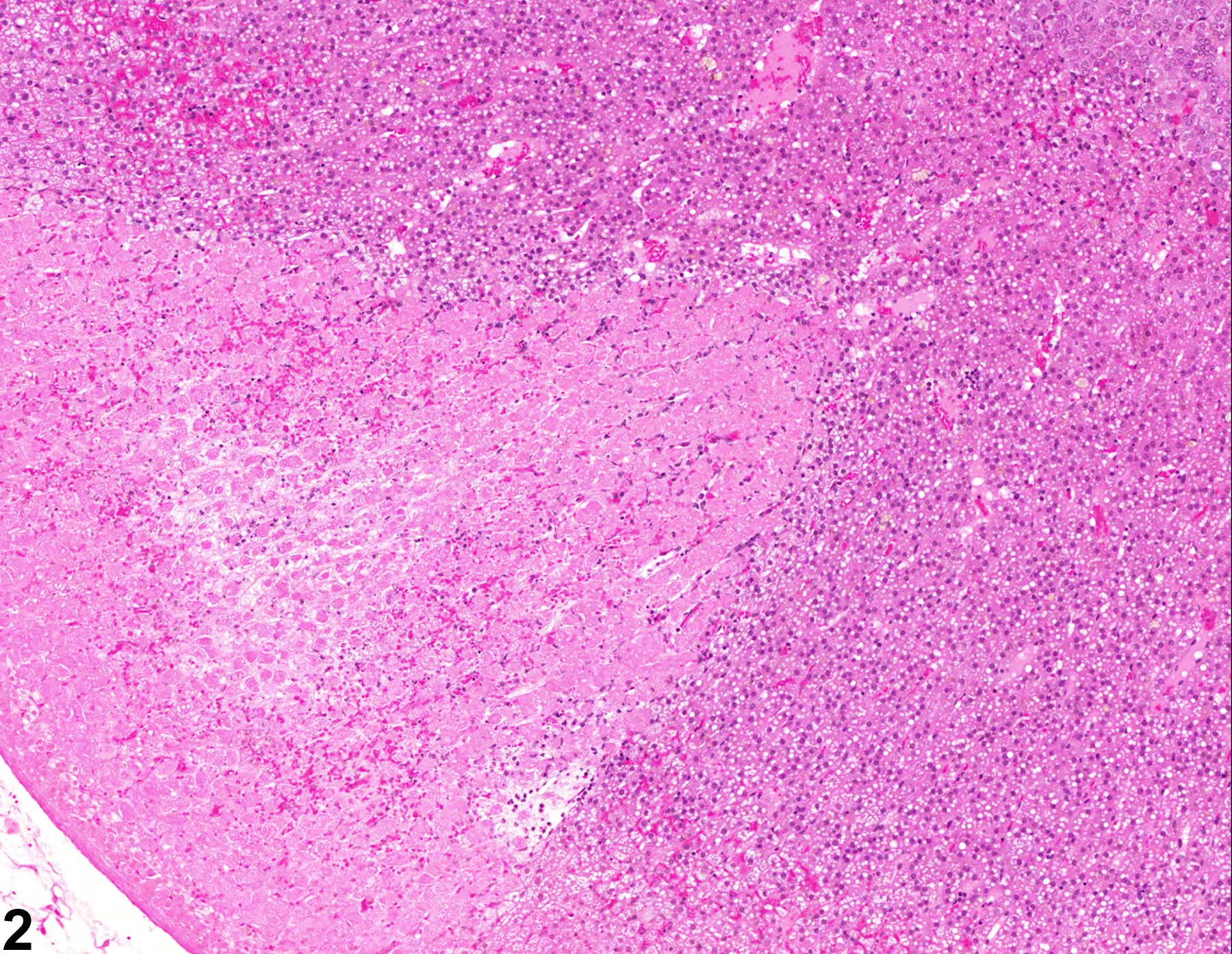 Image of infarct in the adrenal gland cortex from a female F344/N rat in a chronic study
