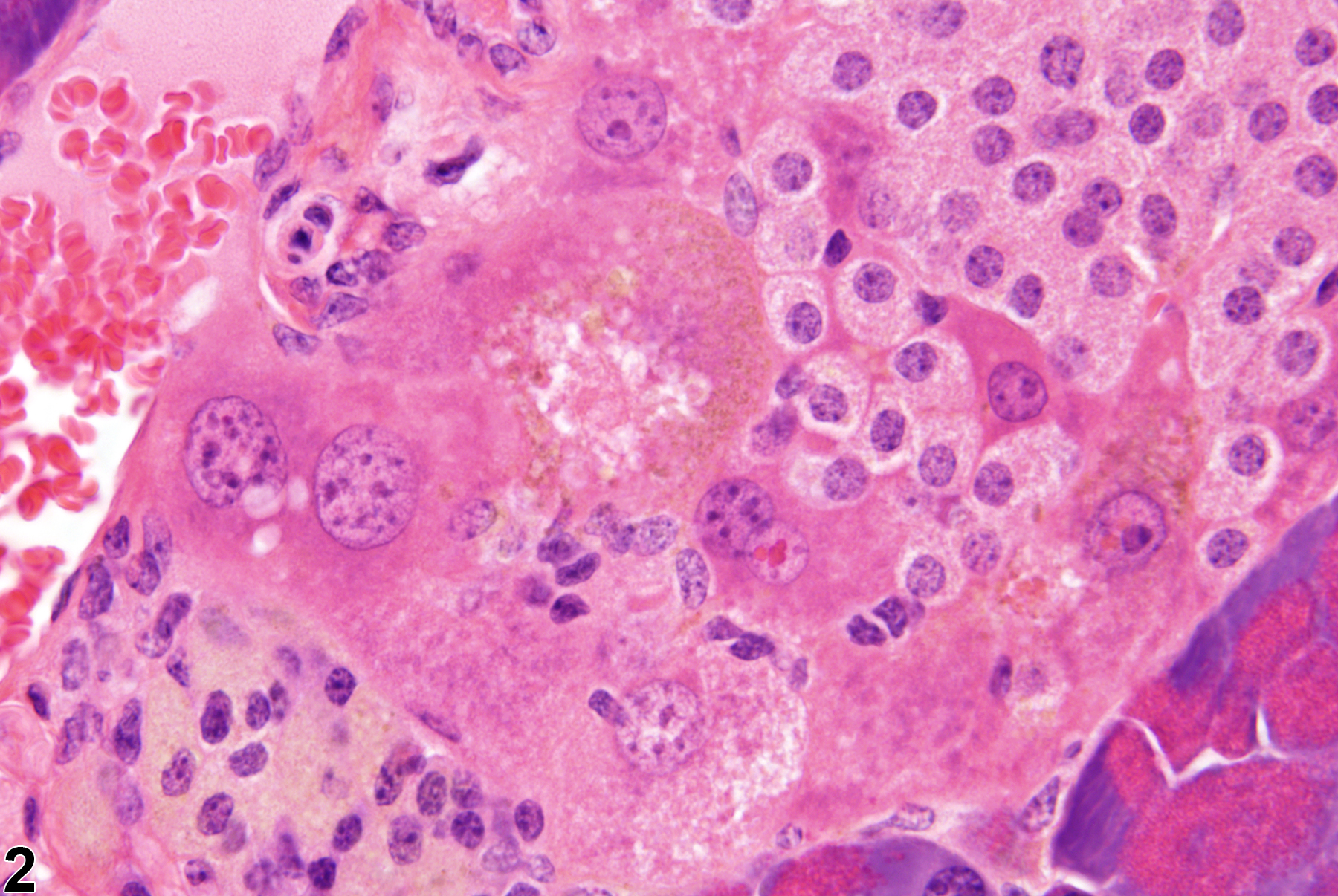Image of metaplasia, hepatocyte in the pancreatic islet from a male B6C3F1 mouse in a chronic study