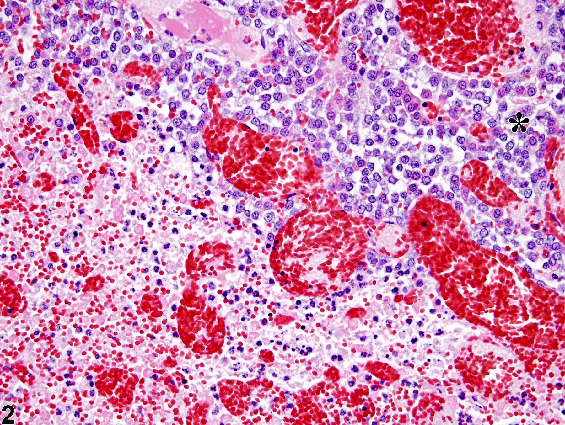 Image of pars distalis necrosis in the pituitary gland from a female F344/N rat in a subchronic study