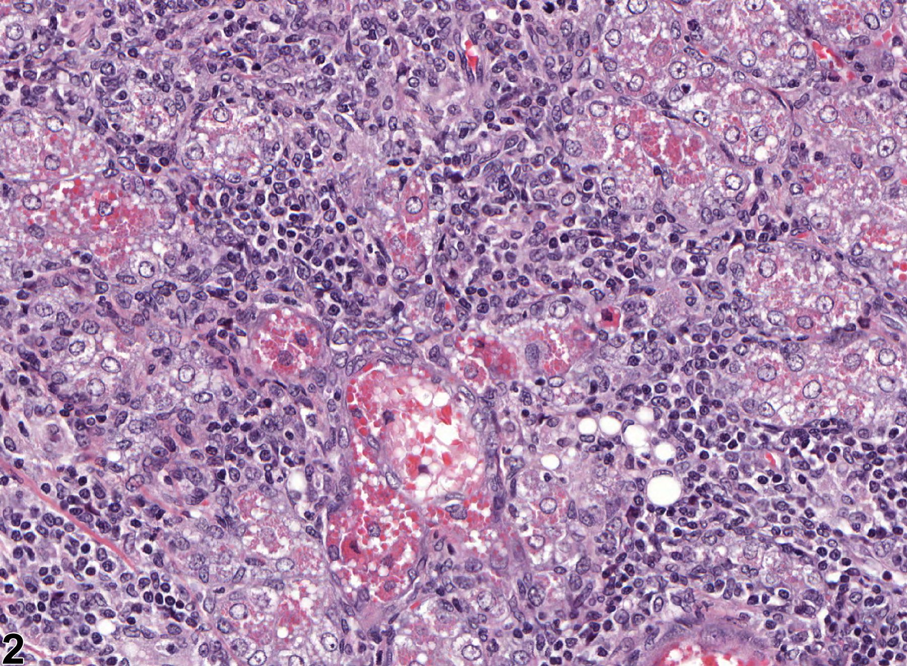 Image of infiltration cellular in the clitoral gland from a female F344/N rat in a chronic study