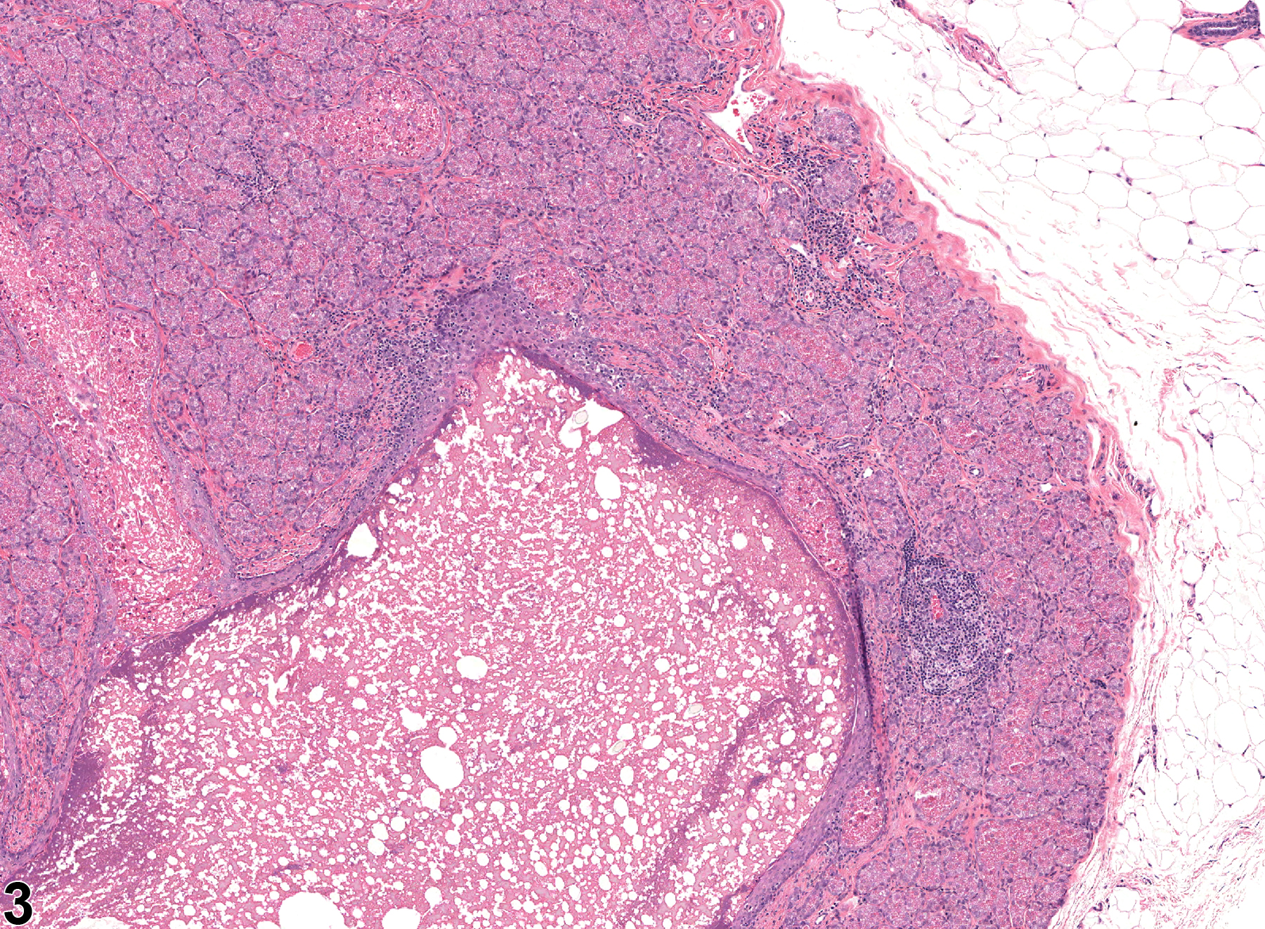 Image of infiltration cellular in the clitoral gland from a female F344/N rat in a subchronic study