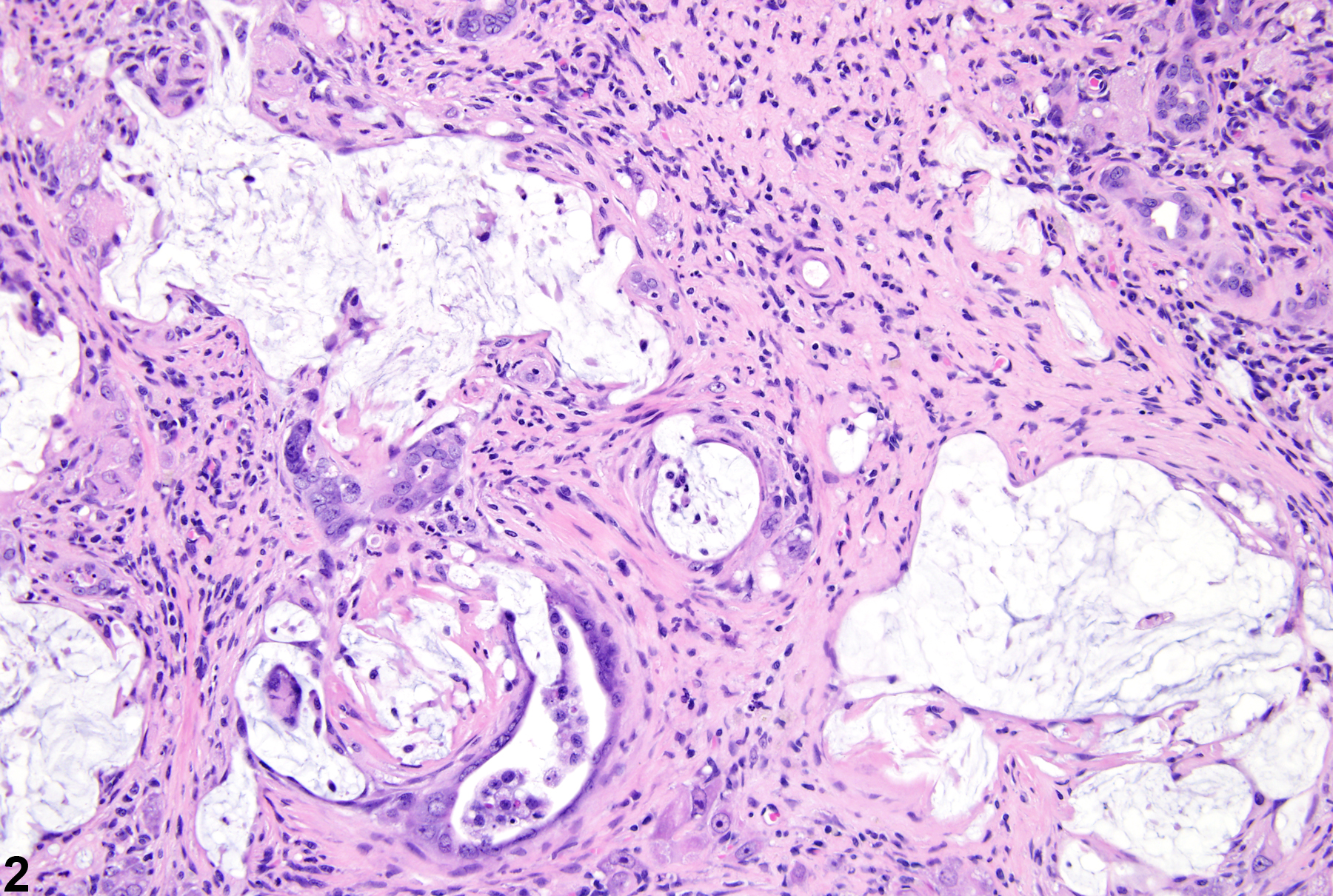 Image of cholangiofibrosis in the liver from a female Harlan Sprague-Dawley rat in a chronic study