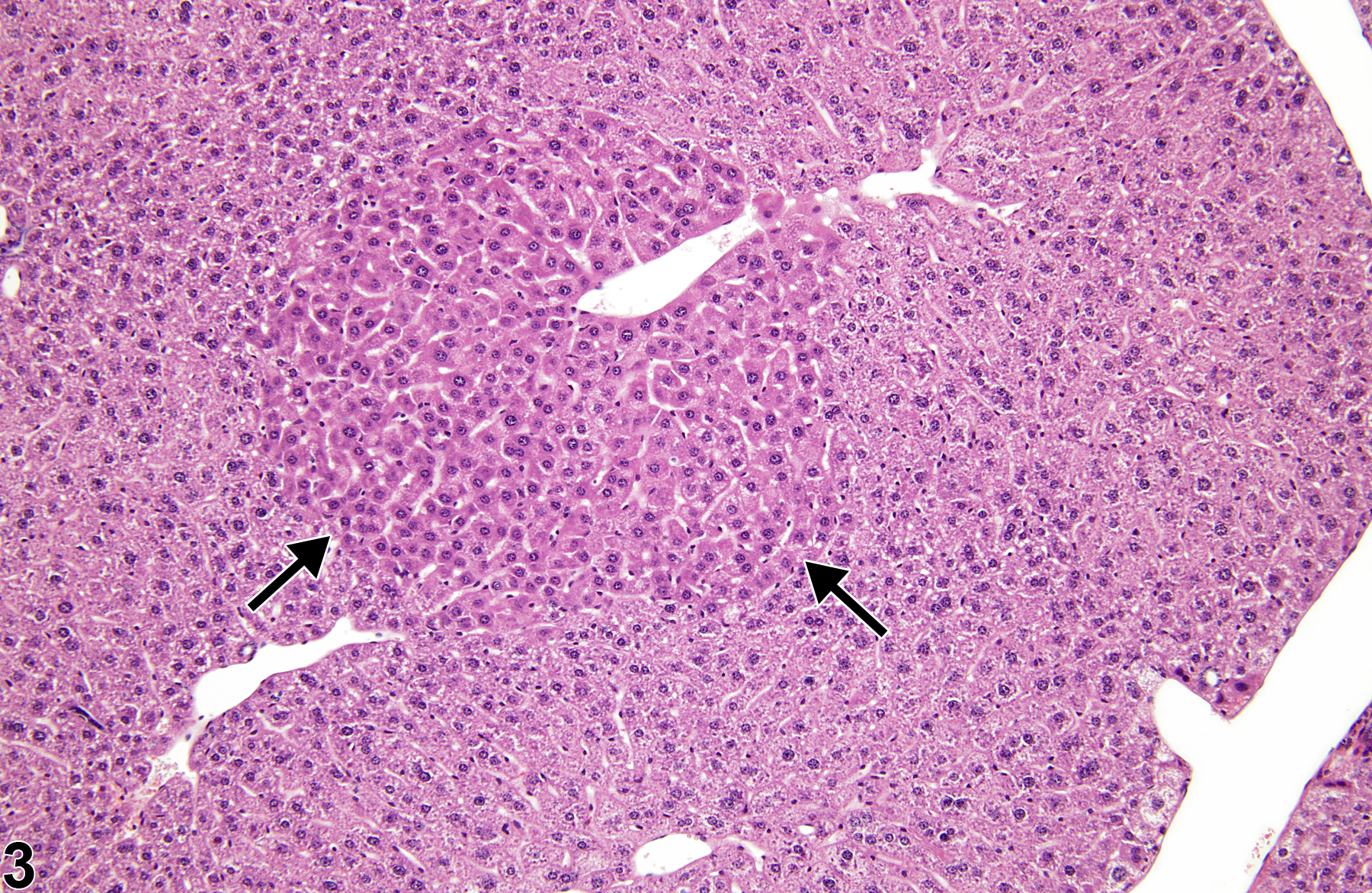 Image of eosinophilic focus in the liver from a male  B6C3F1 mouse in a chronic study