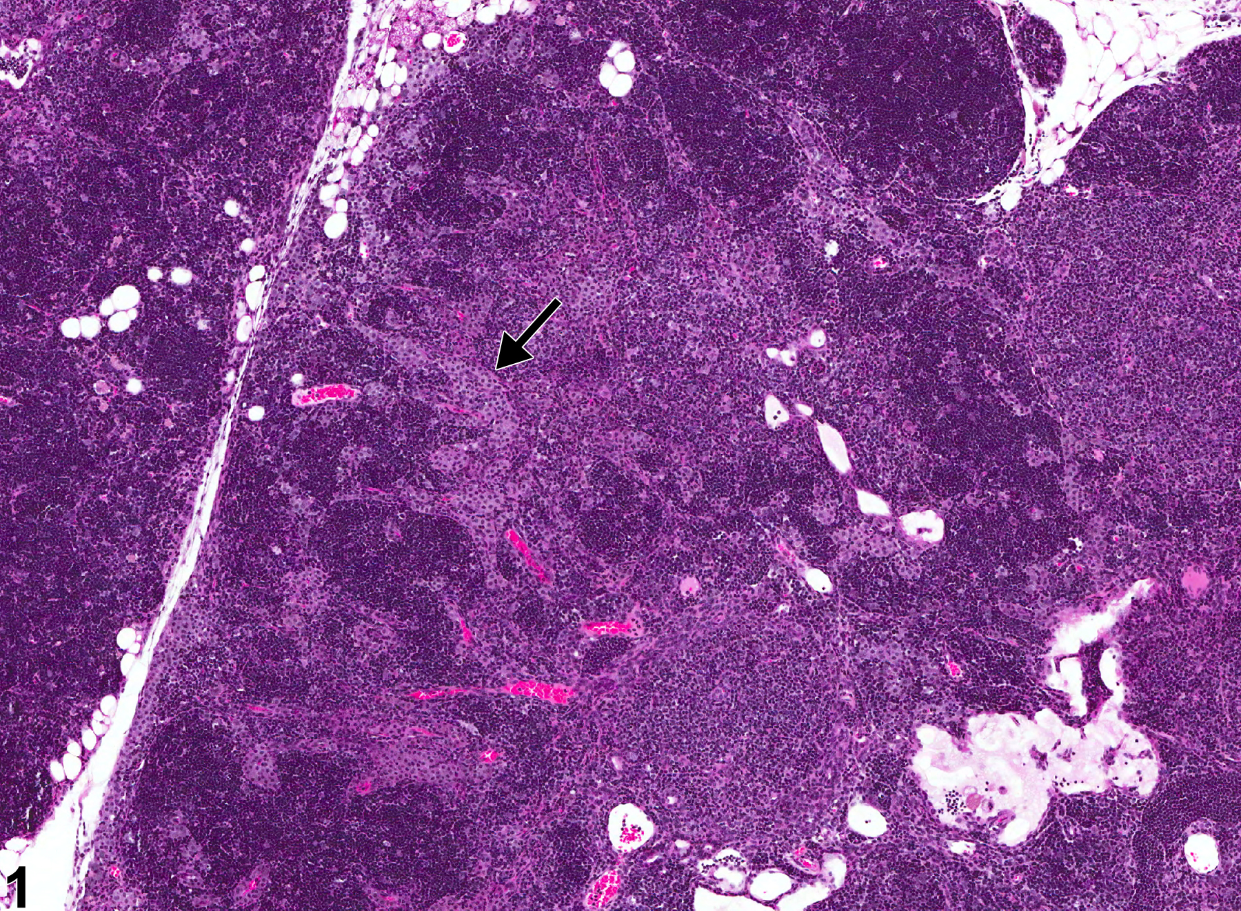 Image of hyperplasia, mast cell in the lymph node from a female B6C3F1/N mouse in a chronic study