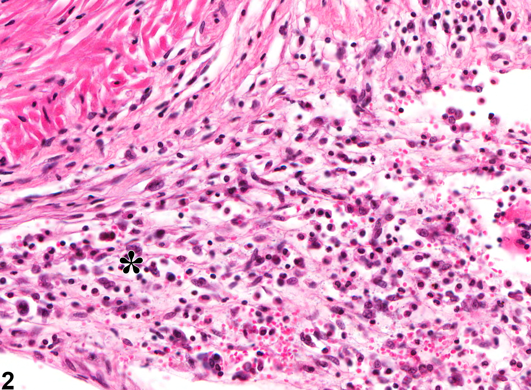 Image of inflammation in the ductus deferens from a male B6C3F1 mouse in a chronic study