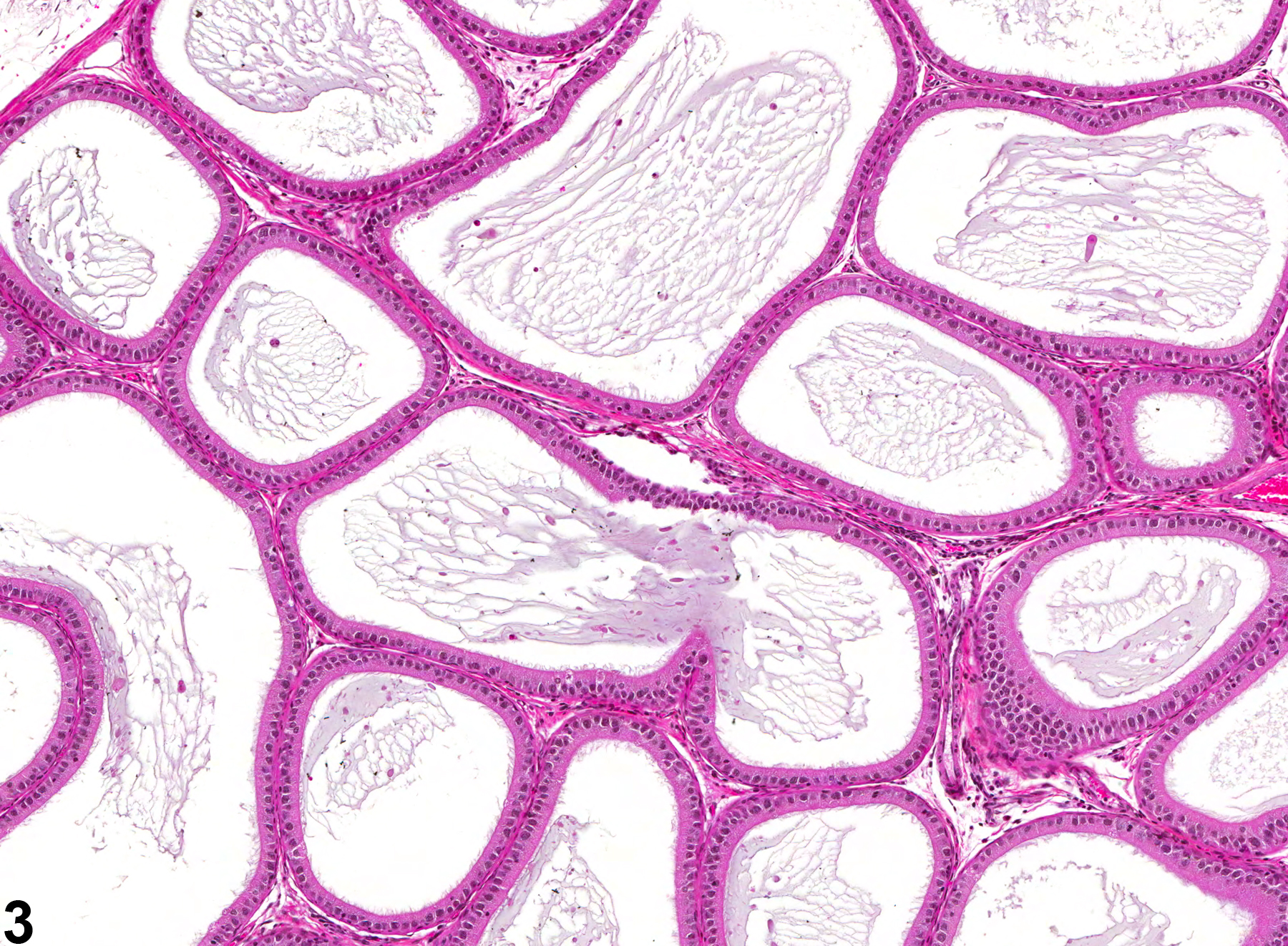 Image of hypospermia in the epididymis from a male F344/N rat in a subchronic study