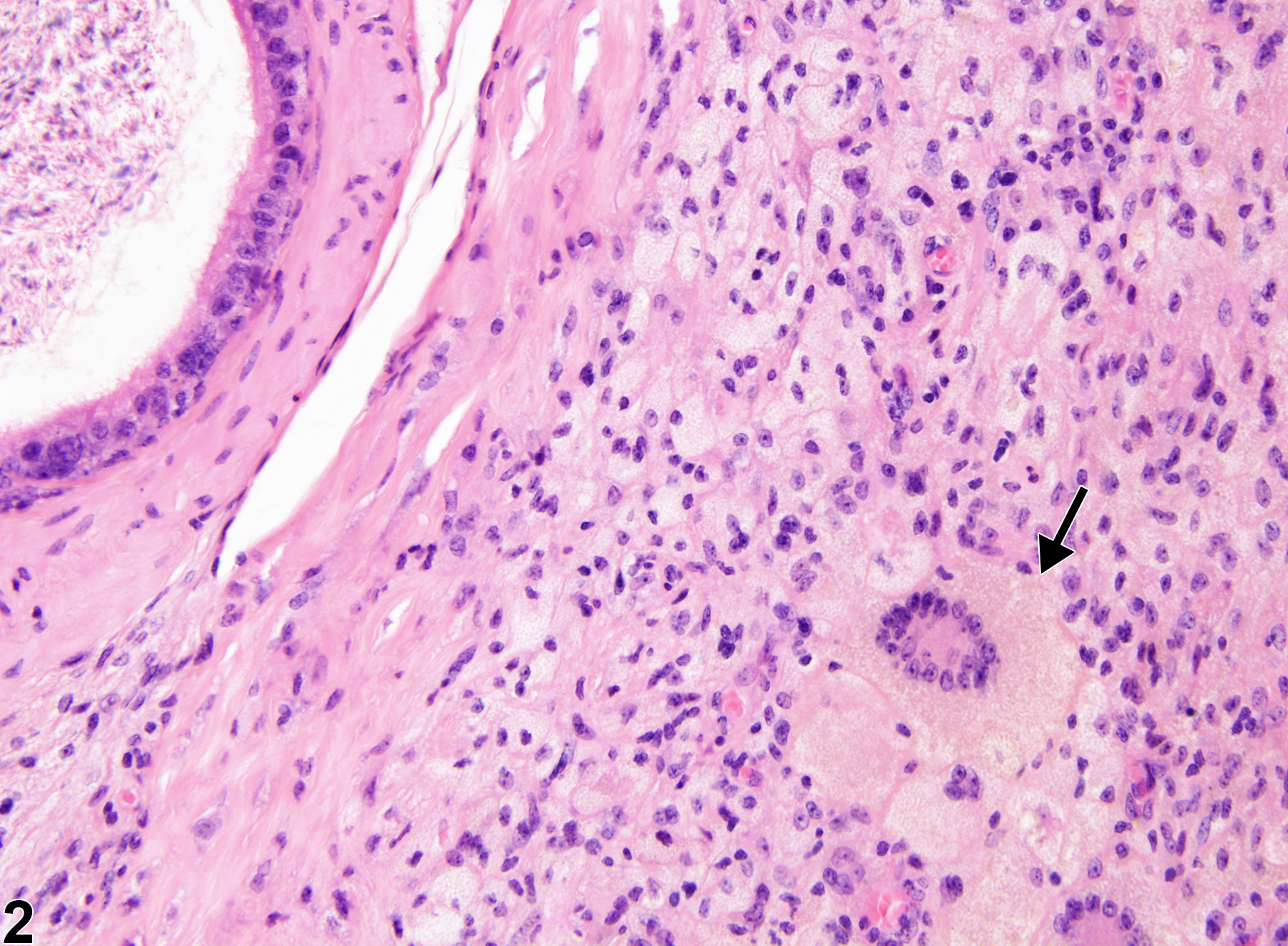 Image of sperm granuloma in the epididymis from a male B6C3F1 mouse in a chronic study