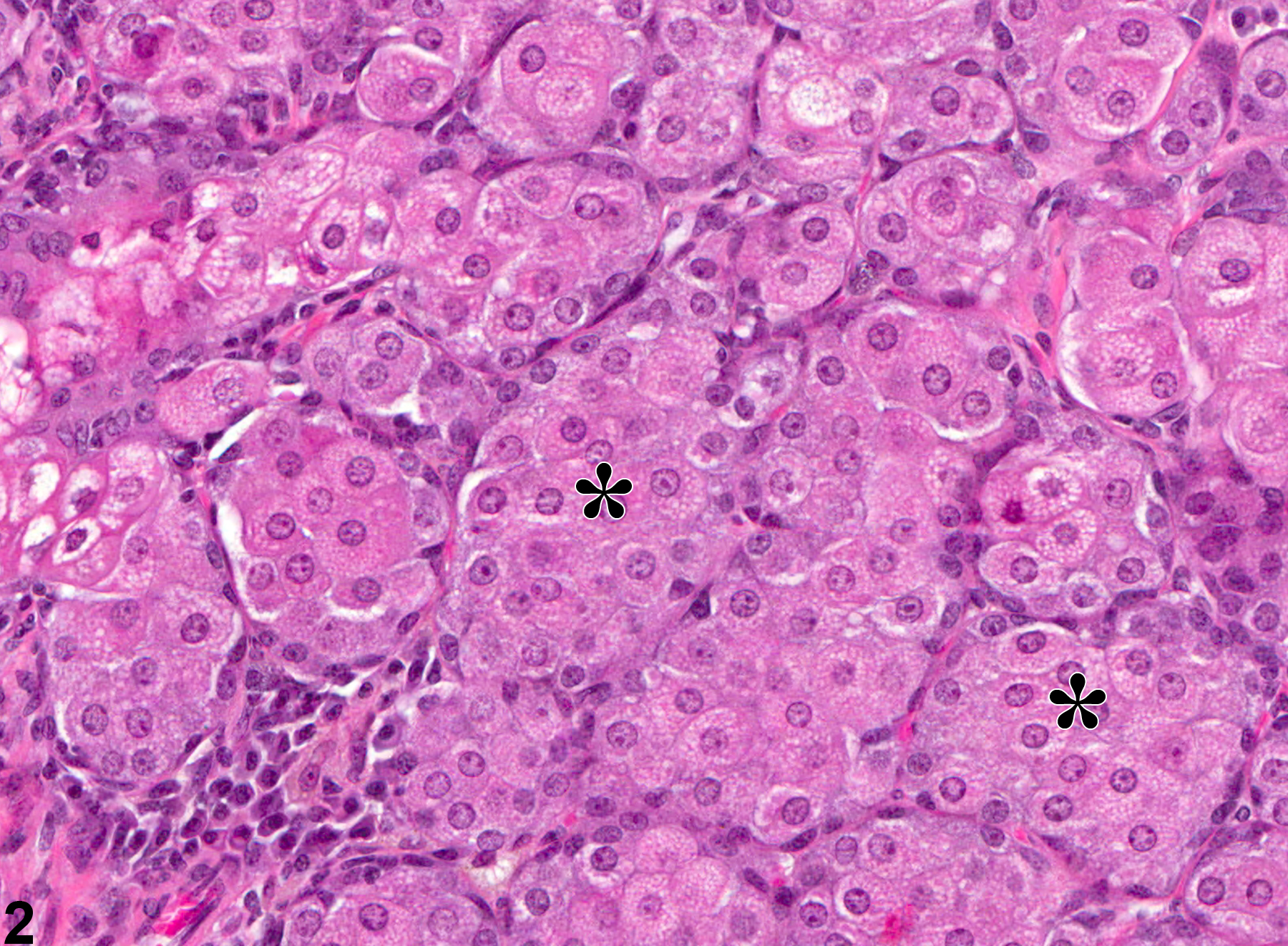 Image of epithelial hyperplasia in the preputial gland from a male F344/N rat in a chronic study
