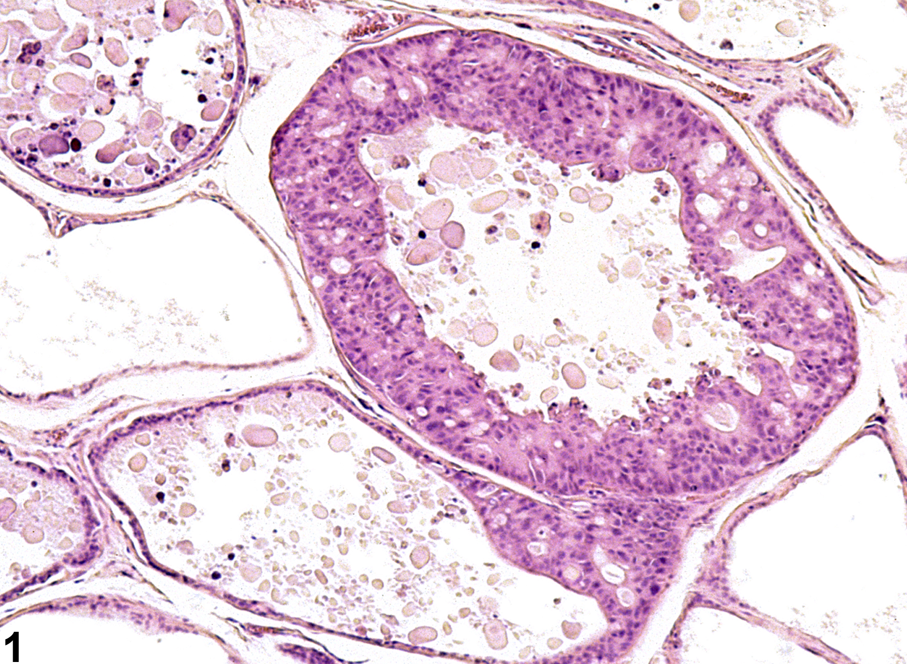 Image of epithelial hyperplasia in the prostate from a male F344/N rat in a chronic study