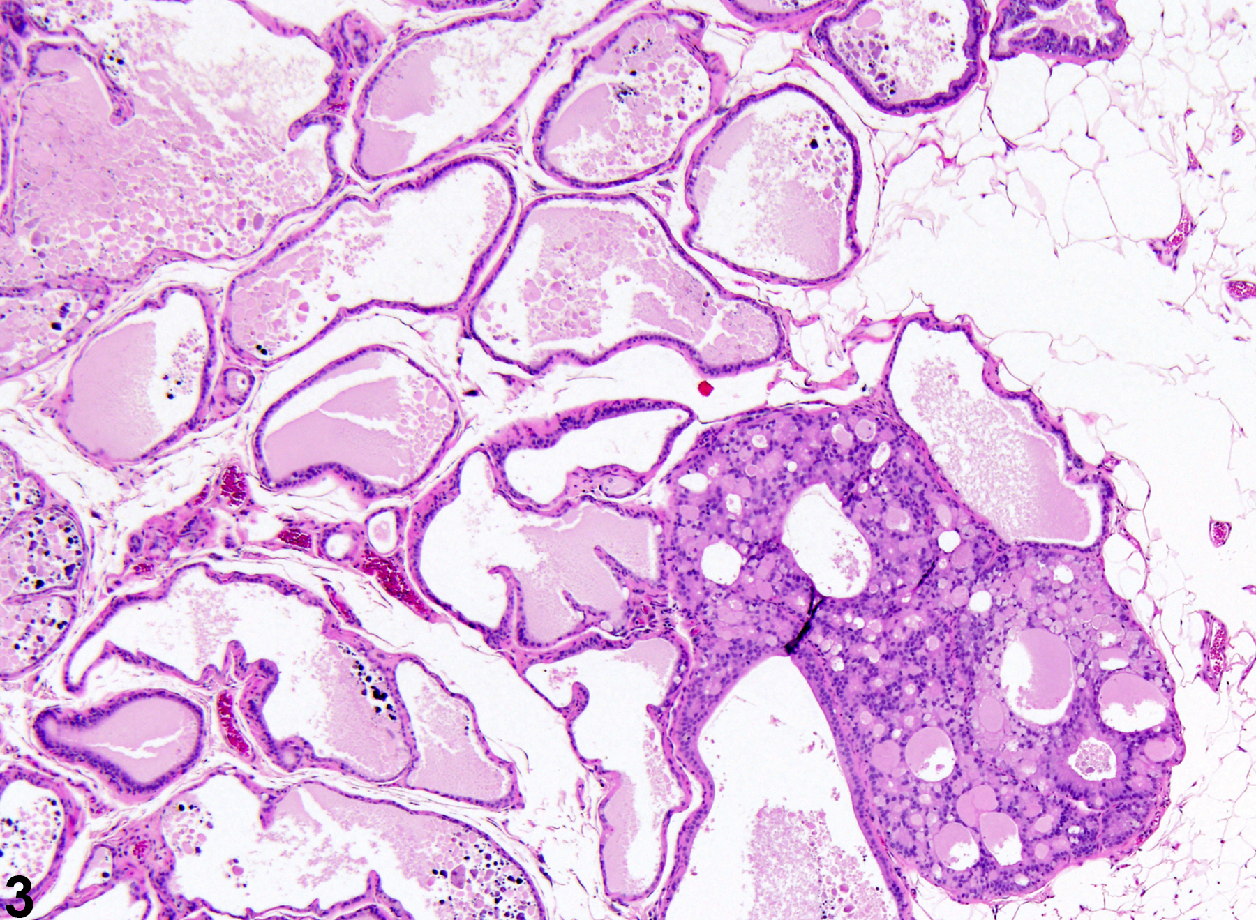 Image of epithelial hyperplasia in the prostate from a male F344/N rat in a chronic study