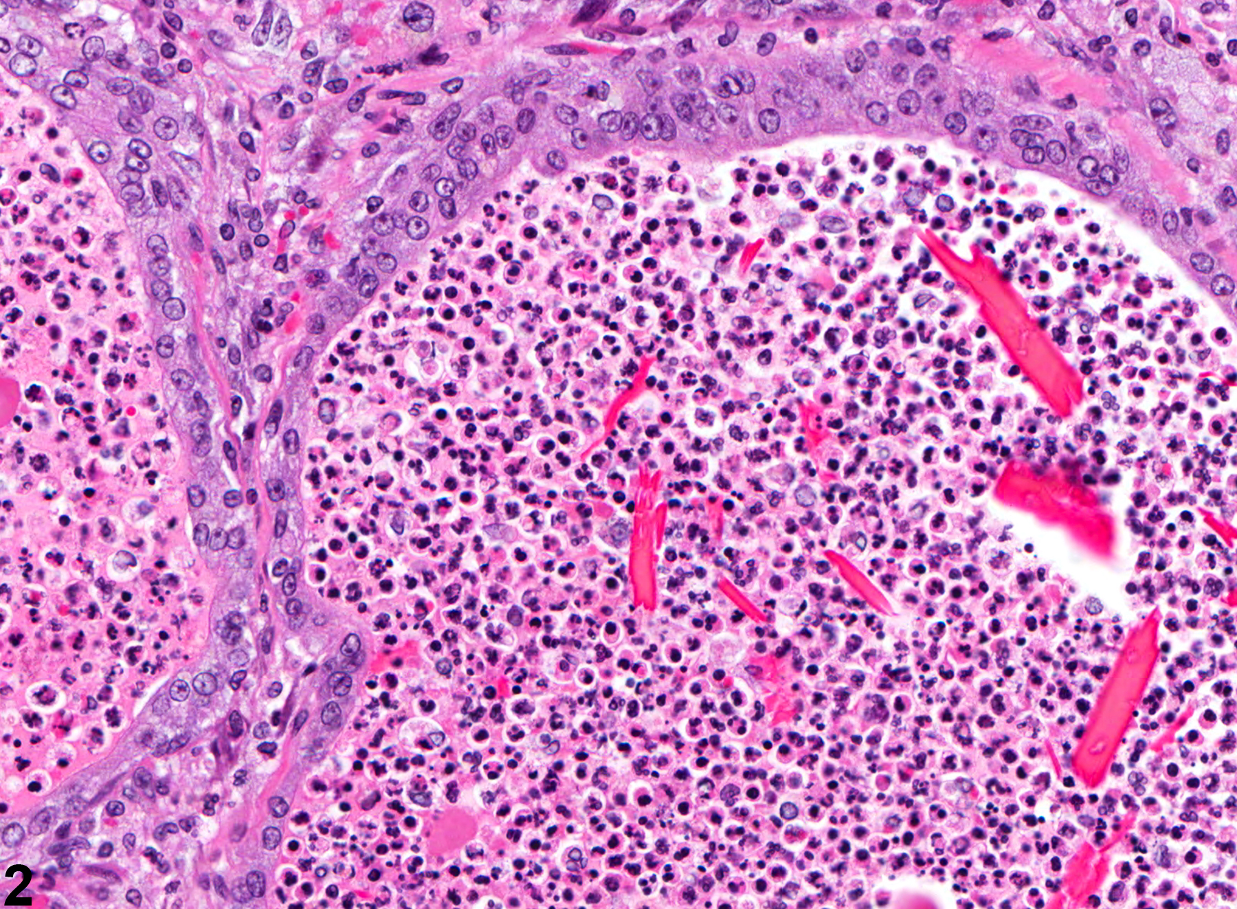 Image of inflammation in the prostate from a male F344/N rat in a chronic study