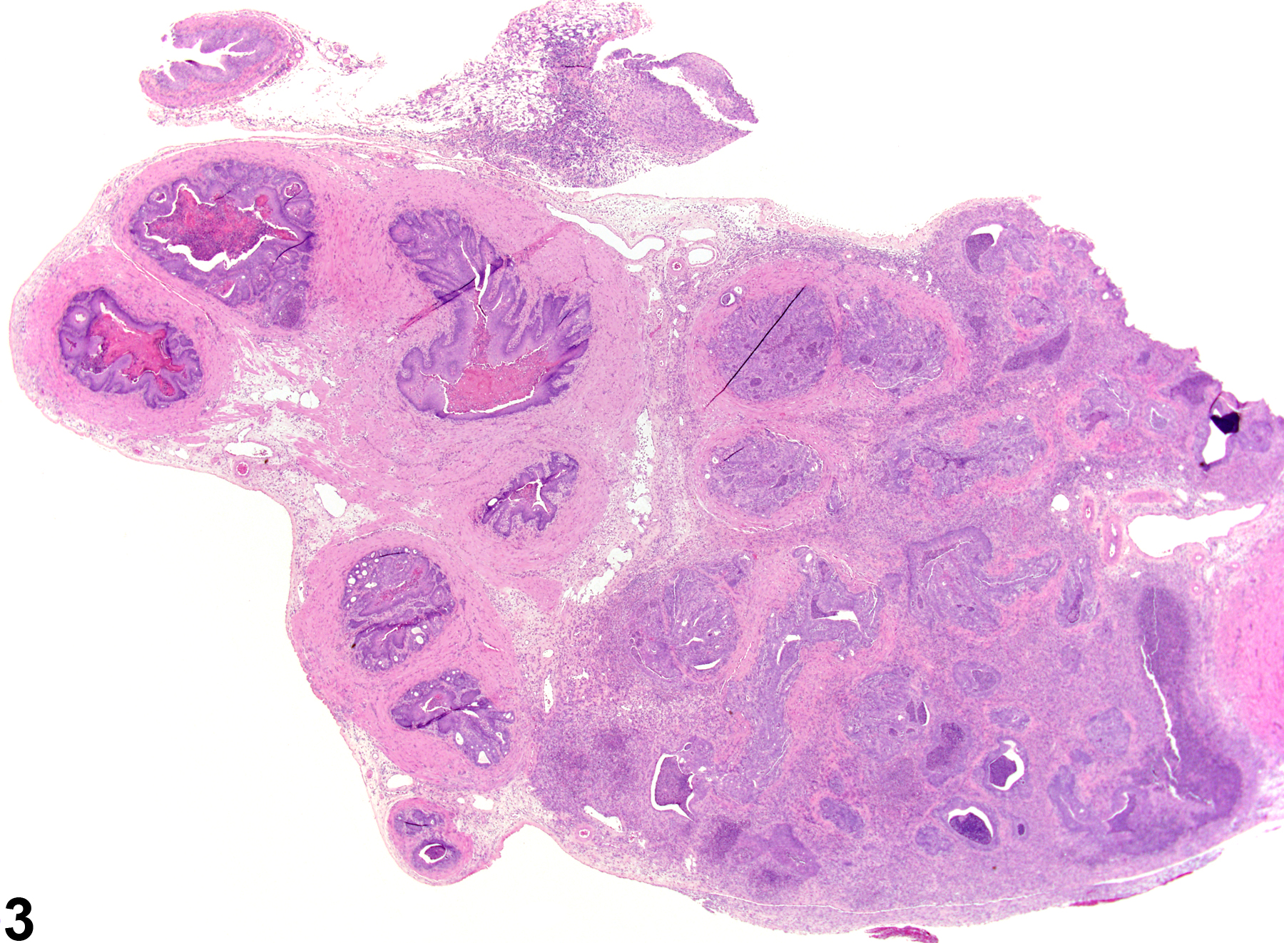 Image of inflammation in the seminal vesicle from a male Harlan Sprague-Dawley rat in an chronic study