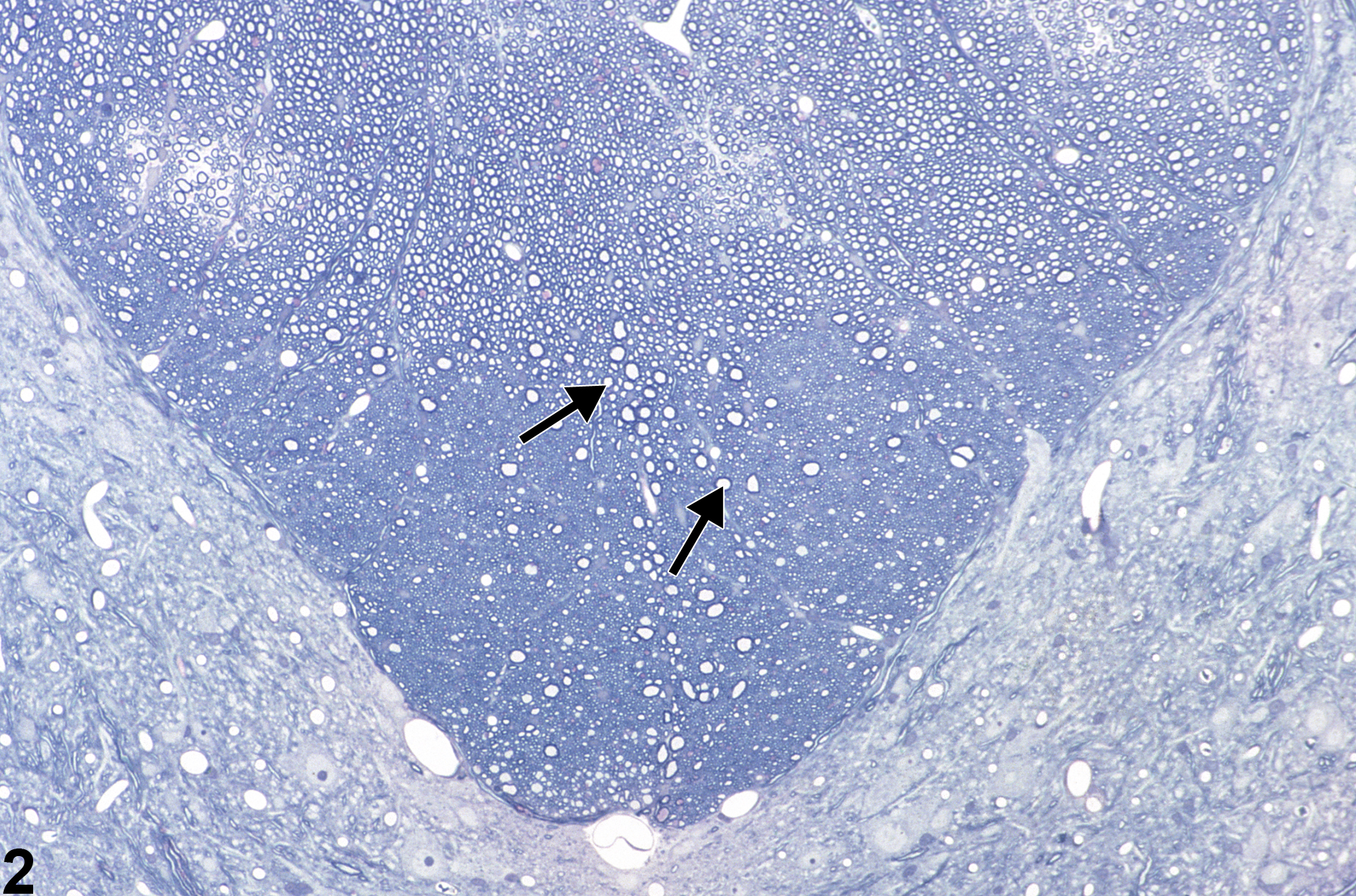 Image of axonopathy in the spinal cord from a male F344/N rat in a subchronic study