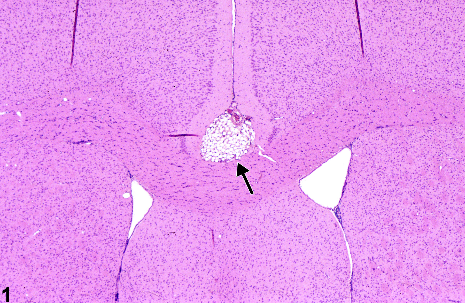 Image of Hamartoma, lipomatous in the Brain from a Male B6C3F1 Mouse in a 2 year  Study