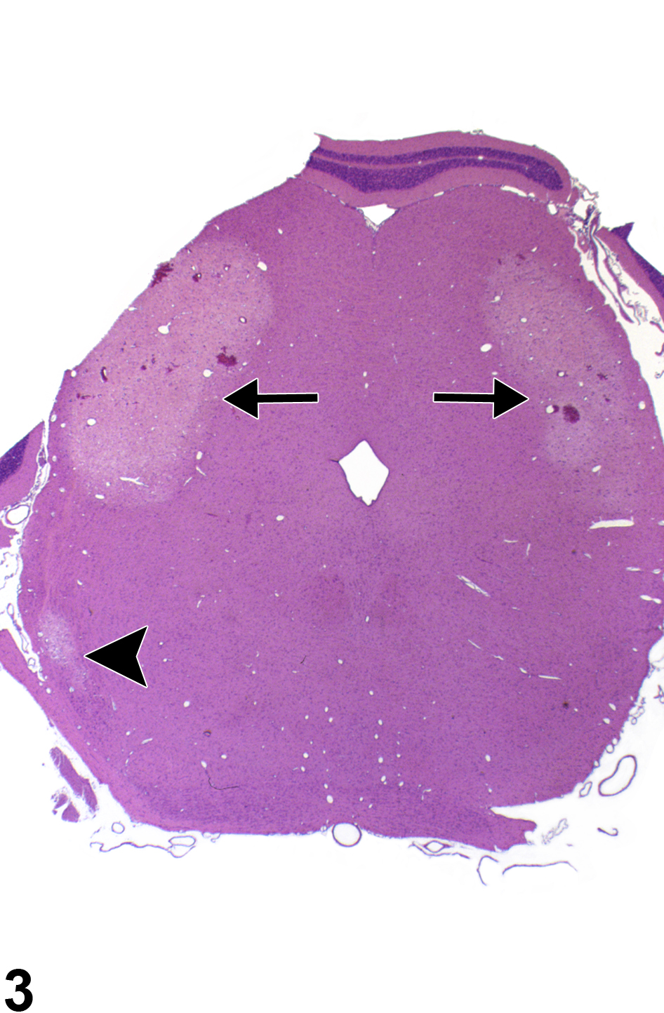 Image of necrosis in the brain from a male F344/N rat in an acute study