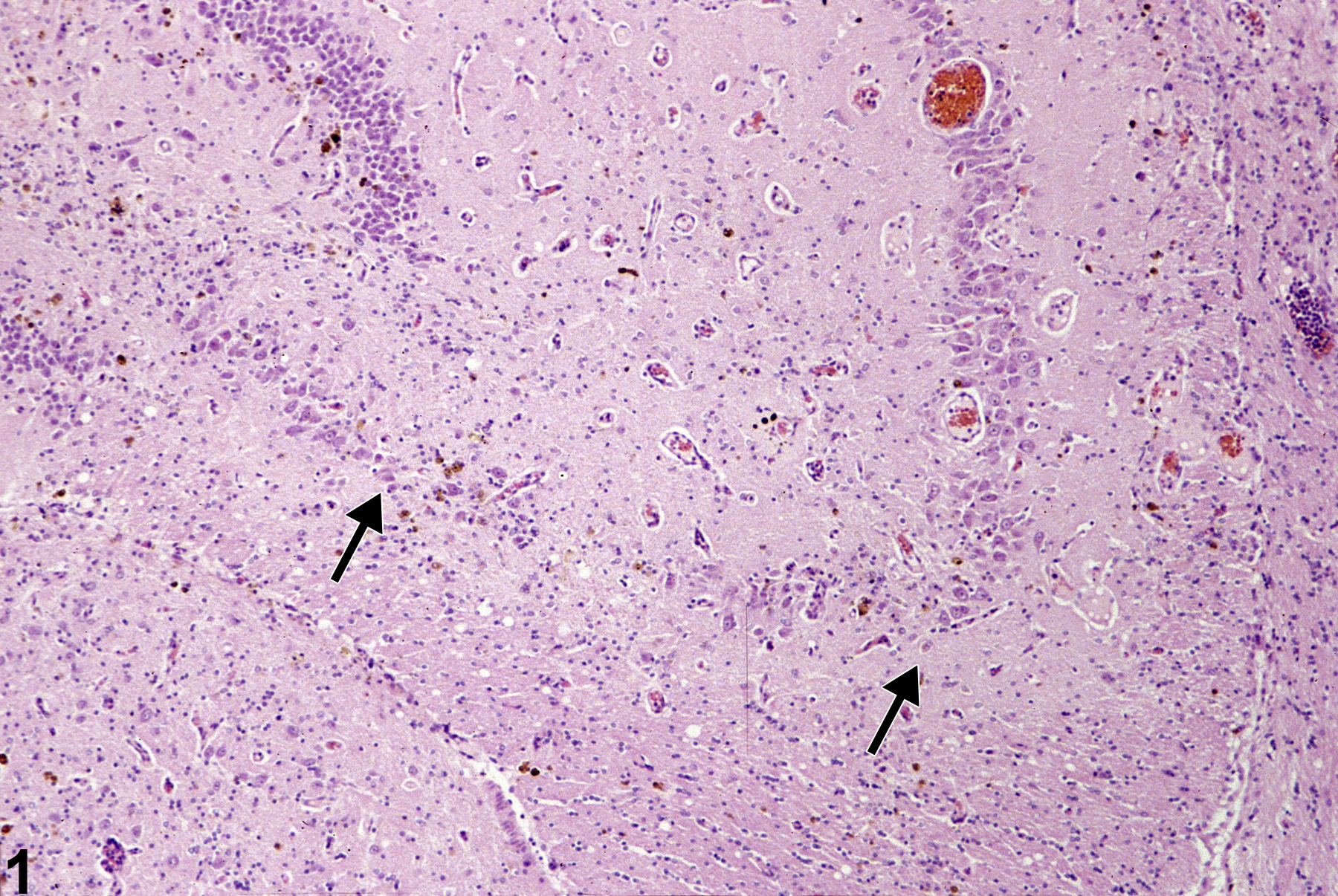 Image of Cell loss in the Brain from a Female F344/N Rat in a 2 year  Study