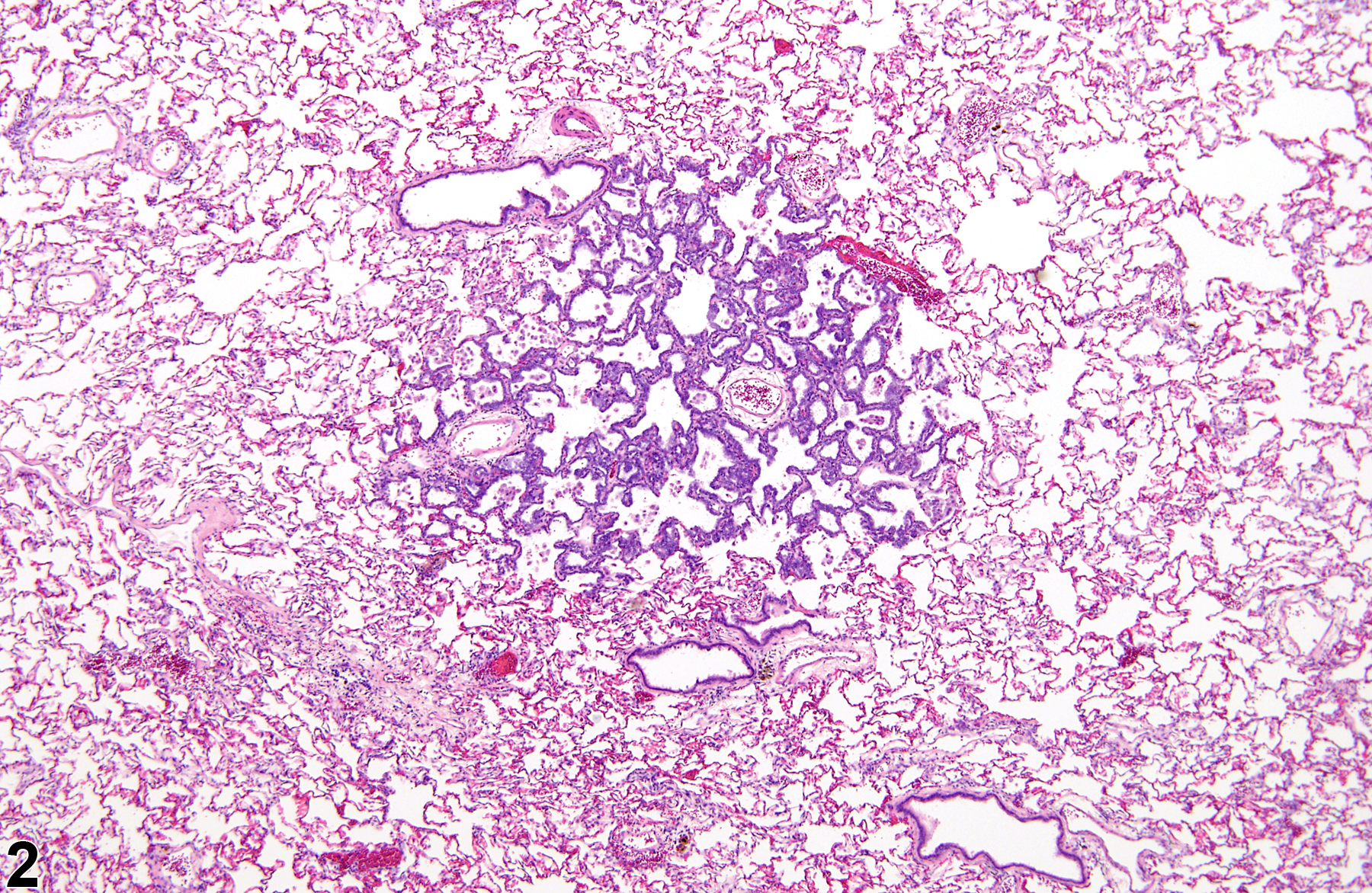 Image of alveolar epithelial hyperplasia in the lung from a male F344/N rat in a chronic study