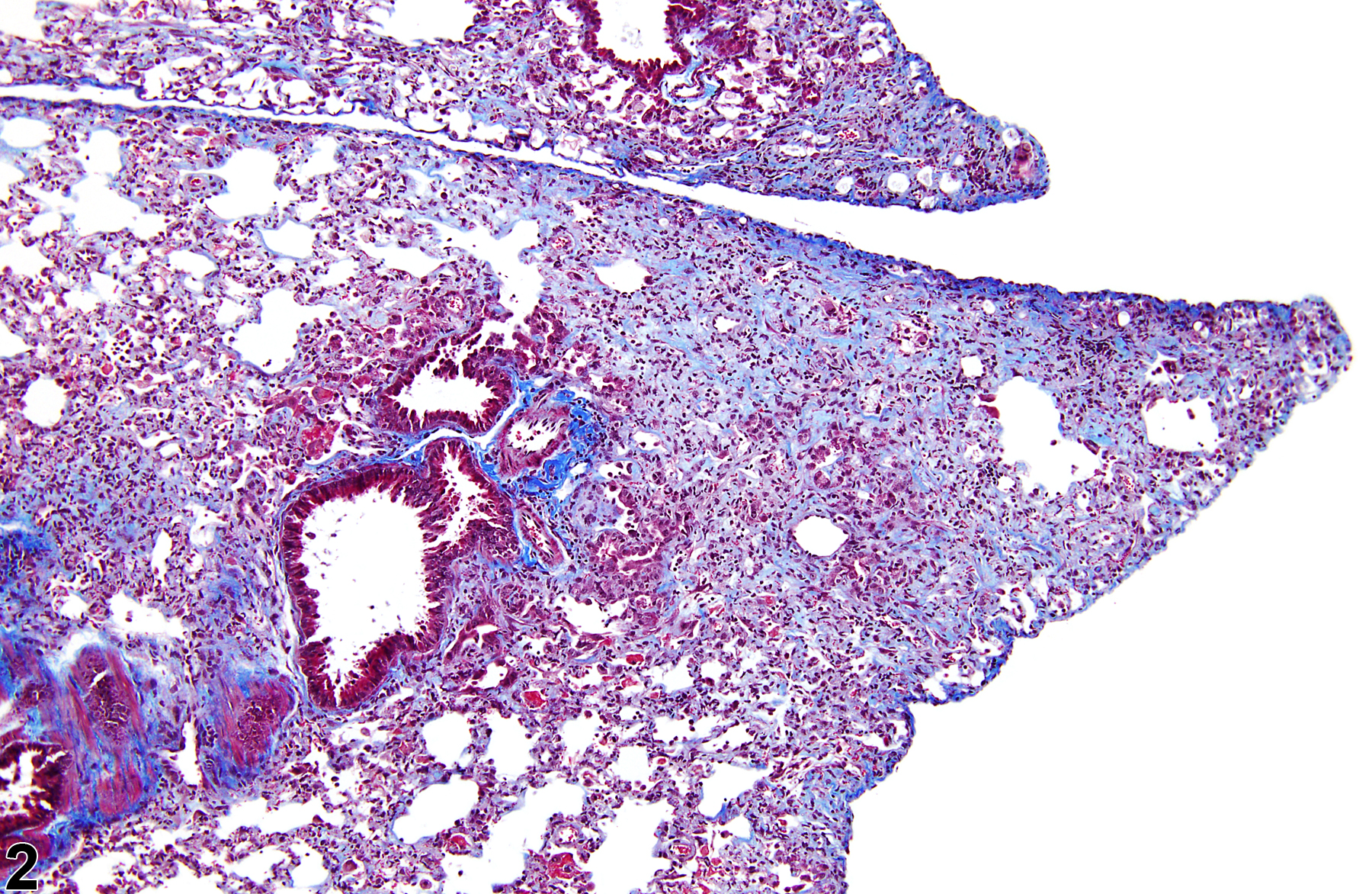 Image of fibrosis in the lung from a mouse