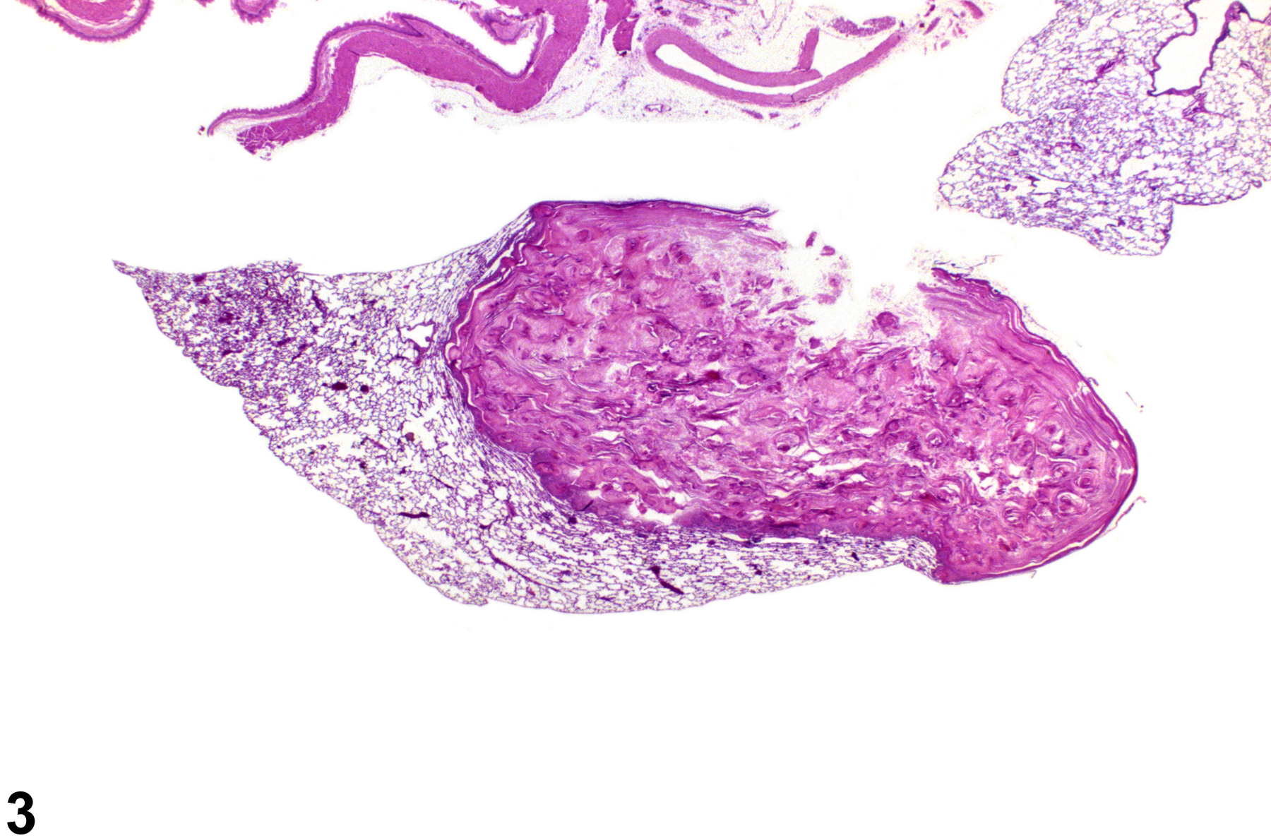 Image of keratinizing cyst in the lung from a female F344/N rat in a chronic study