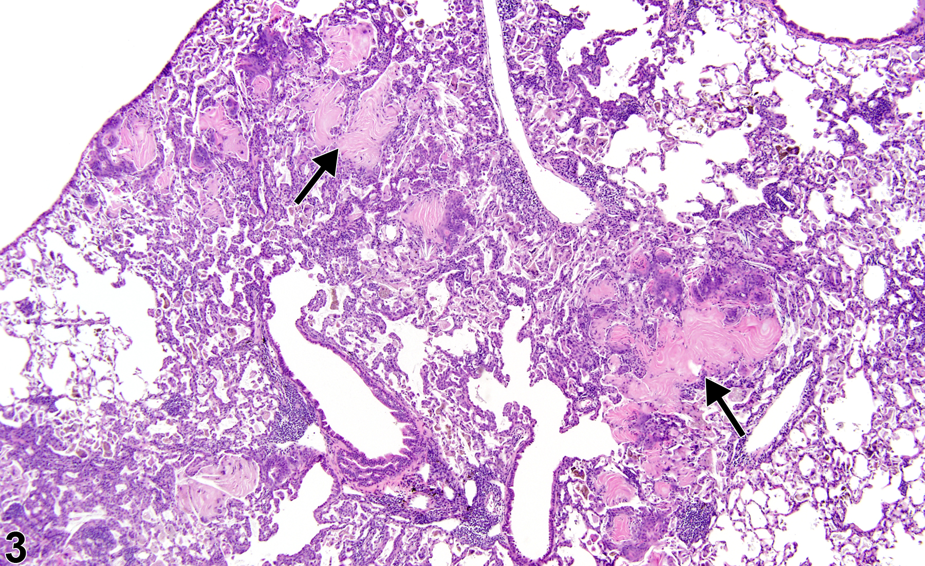 Image of alveolar squamous metaplasia in the lung from a female Harlan Sprague-Dawley rat in a chronic study