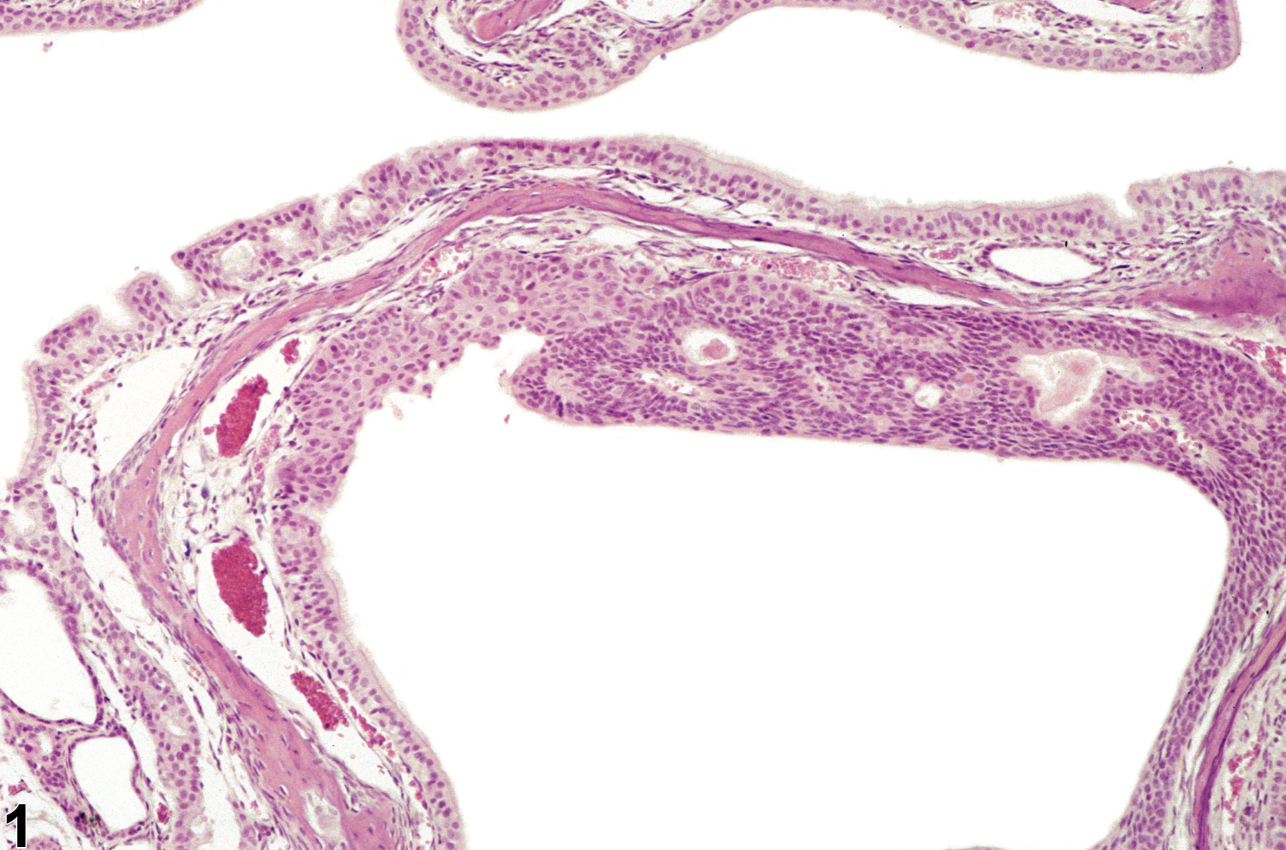 Image of hyperplasia, atypical in the nose, respiratory epithelium from a male B6C3F1/N mouse in a chronic study