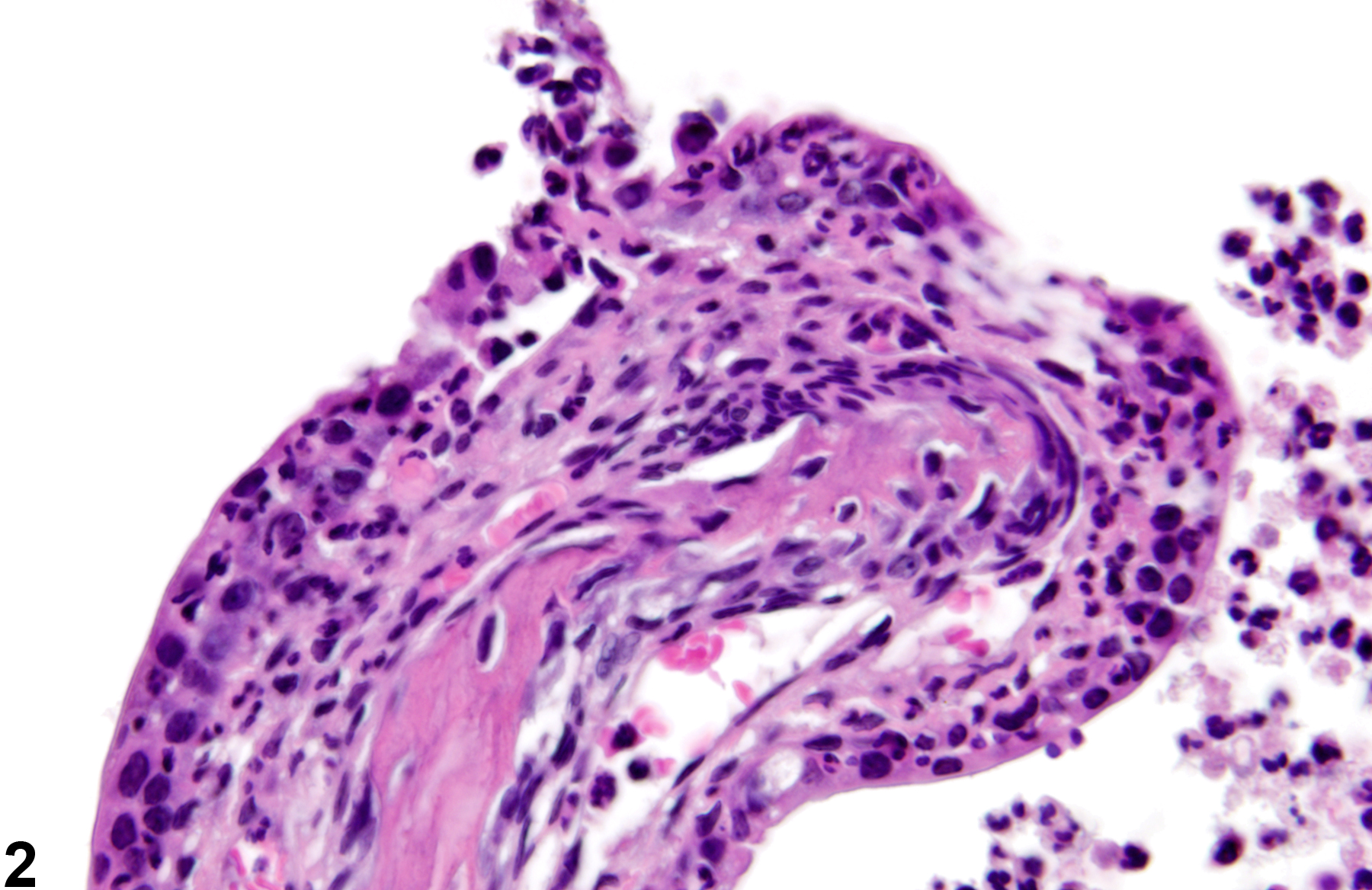 Image of necrosis in the nose, transitional epithelium from a female B6C3F1/N mouse in a chronic study