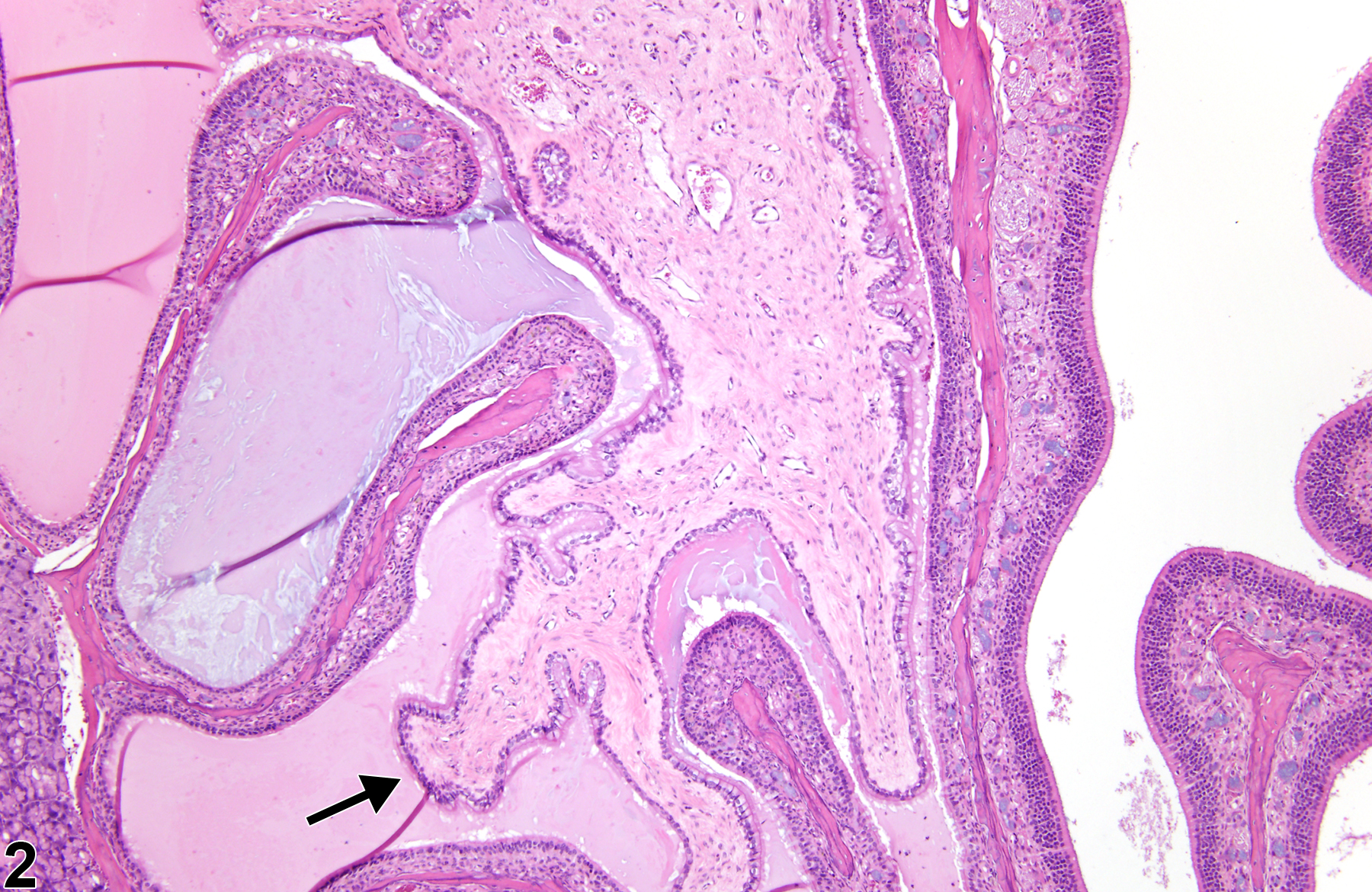 Image of polyp, inflammatory in the nose from a male B6C3F1/N mouse in a chronic study