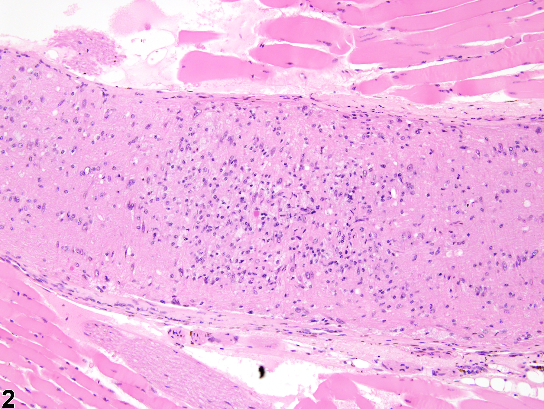 Image of optic nerve gliosis in the eye from a male B6C3F1 mouse in a chronic study
