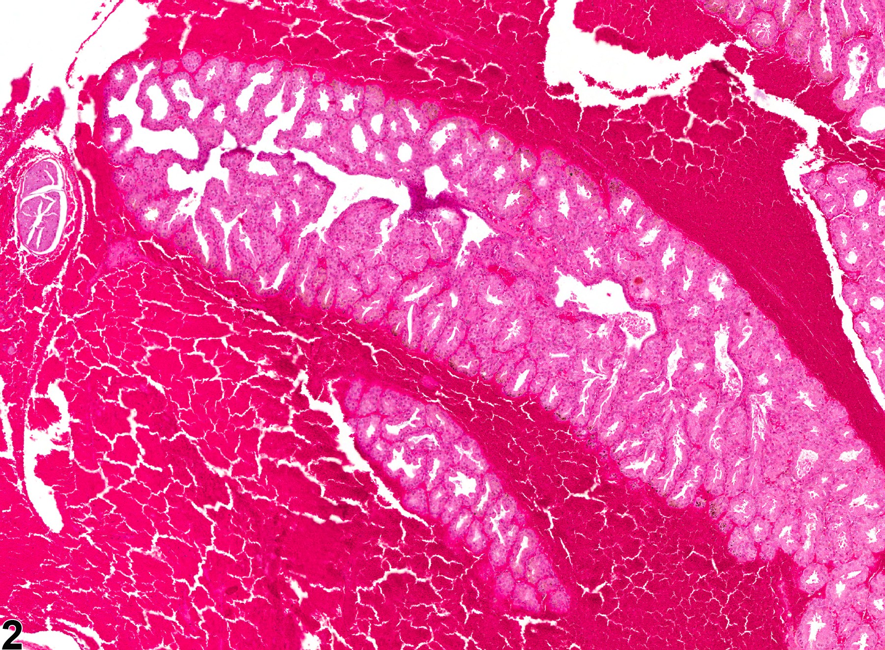 Image of hemorrhage in the Harderian gland from a male F344/N rat in a chronic study