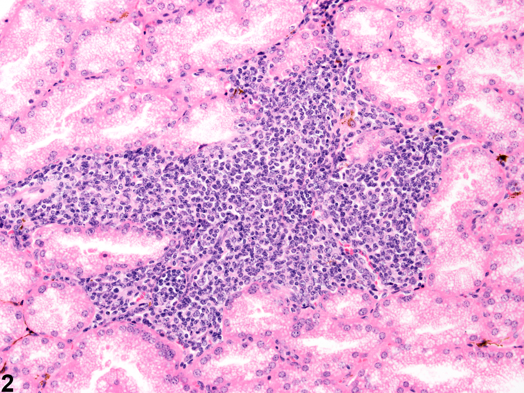 Image of infiltration cellular, mononuclear cell in the Harderian gland from a female B6C3F1 mouse in a chronic study