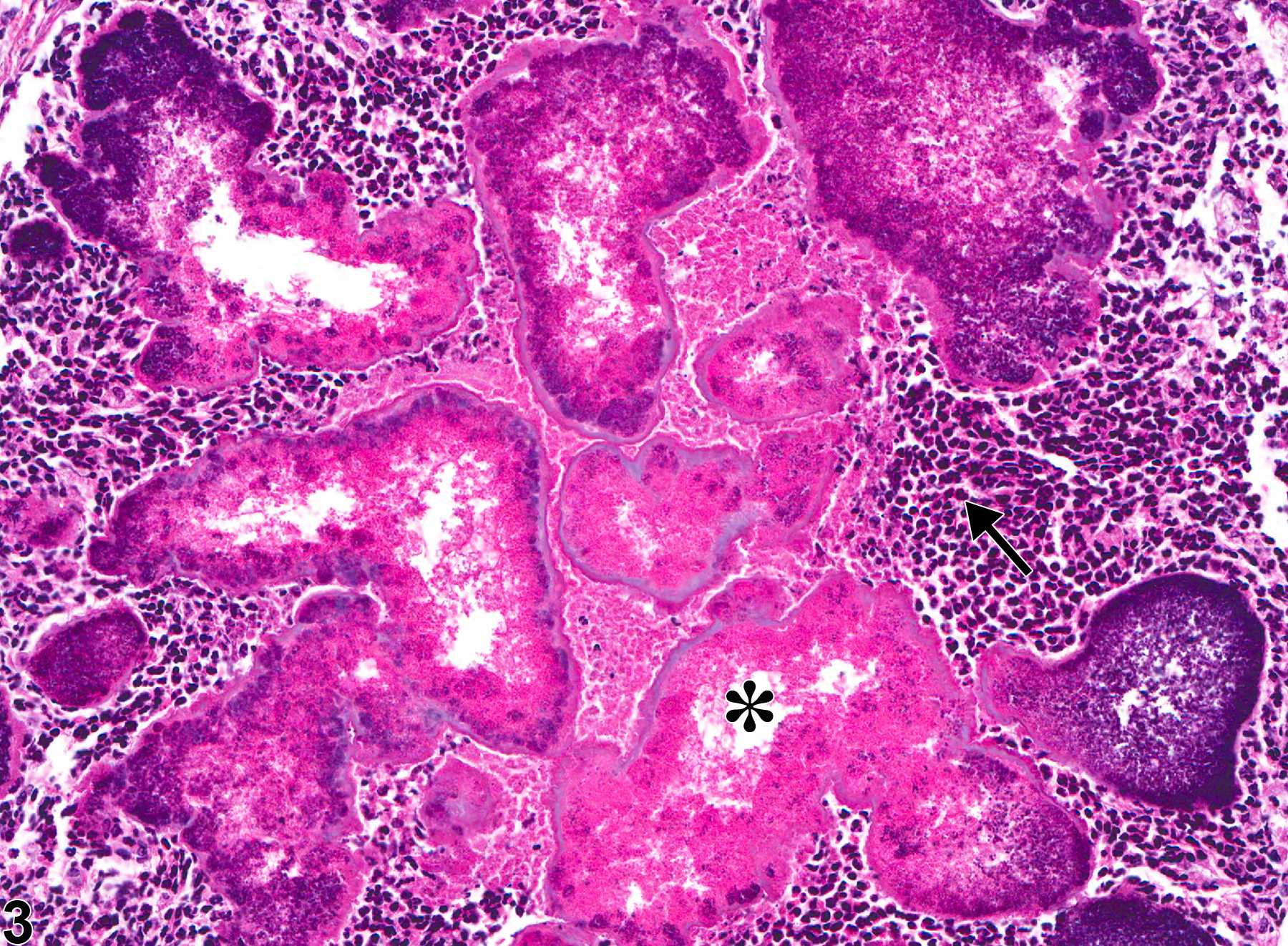 Image of inflammation in the Harderian gland from a male B6C3F1 mouse in a chronic study