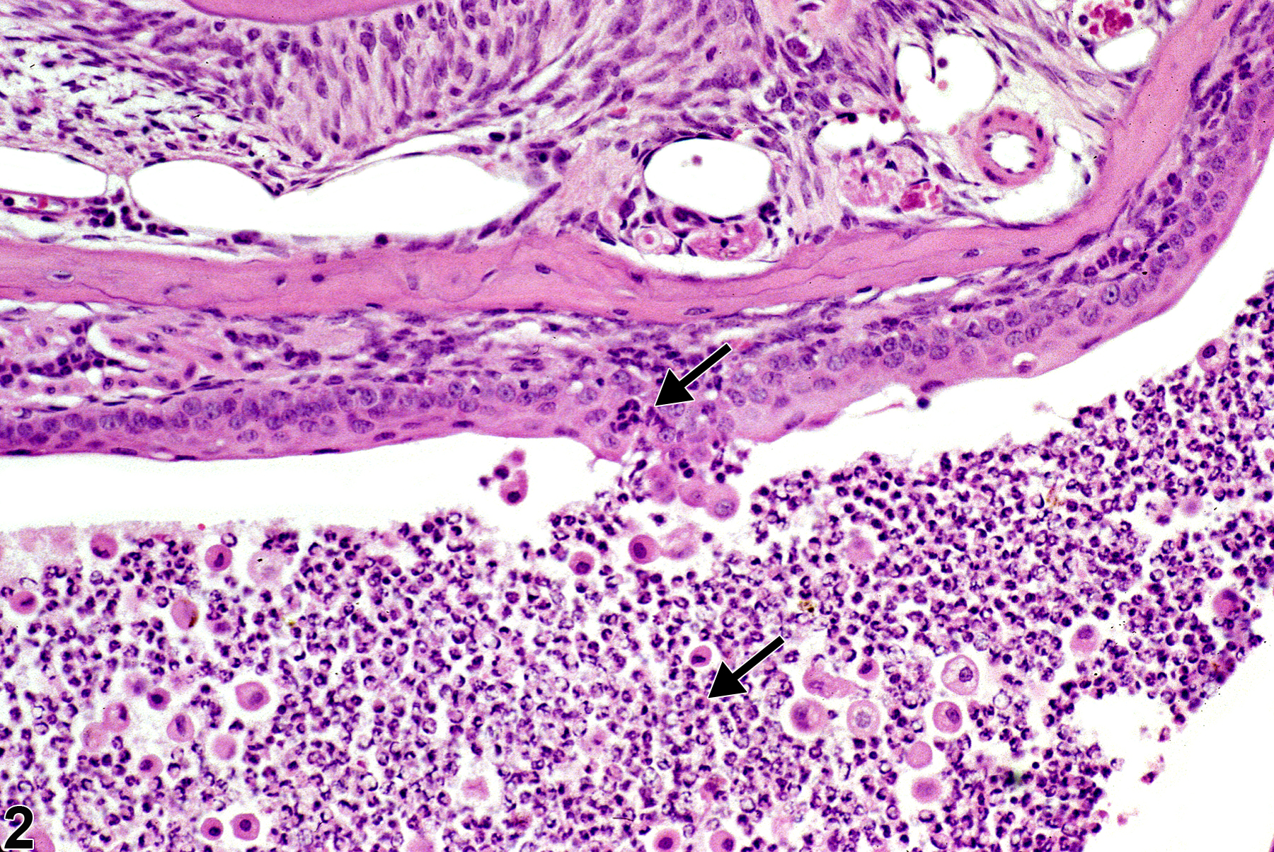Image of inflammation in the lacrimal gland from a male B6C3F1 mouse in a chronic study
