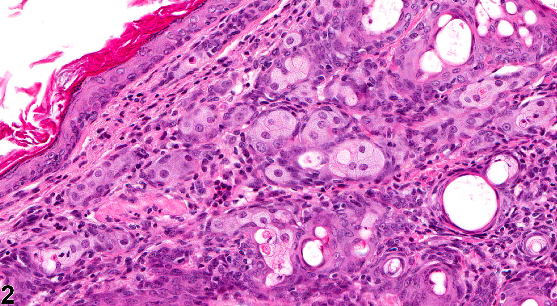 Image of inflammation in the Zymbal's gland from a male Tg.Ac (FVB/N) homozygous mouse in a subchronic study