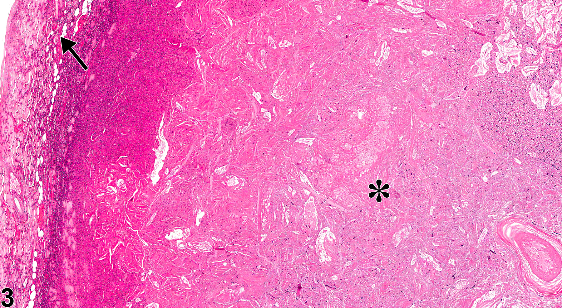 Image of inflammation in the Zymbal's gland from a male B6C3F1 mouse in a chronic study