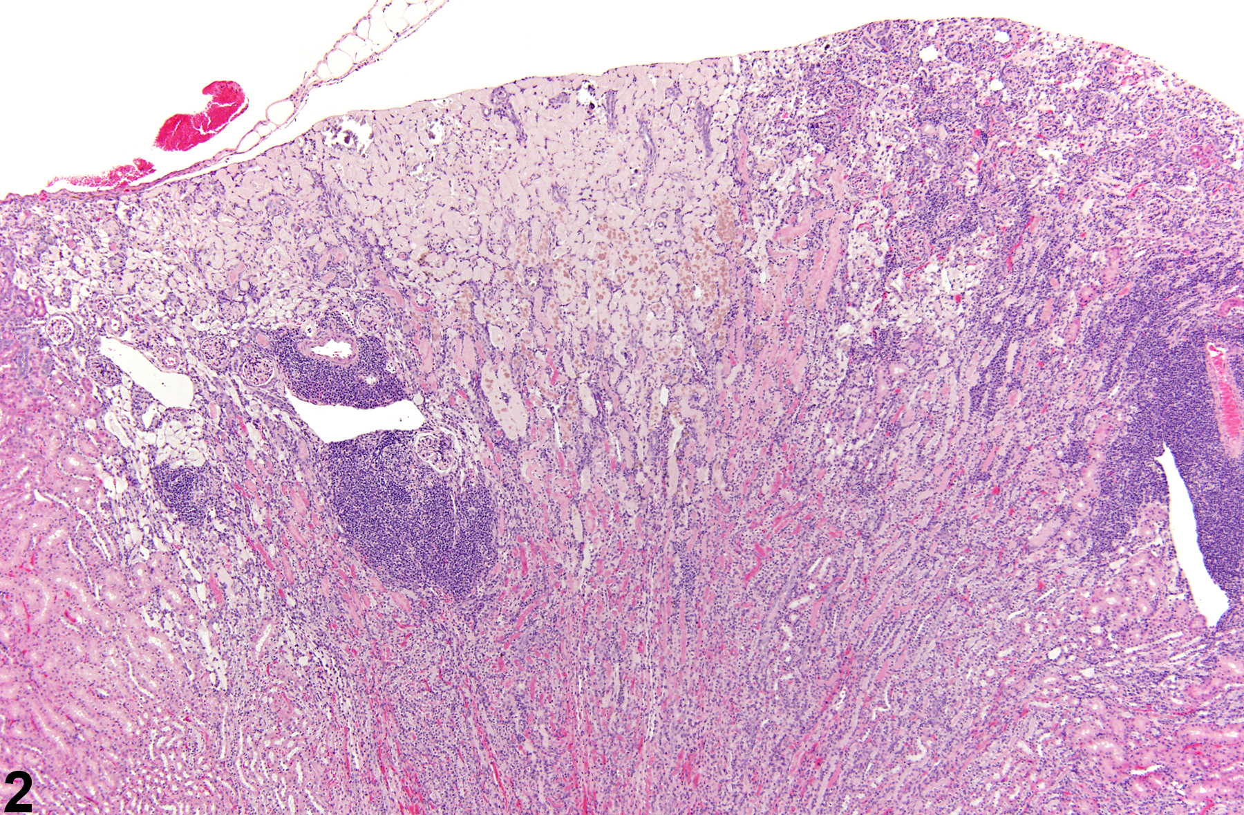 Image of infarct in the kidney from a female B6C3F1 mouse in a chronic study