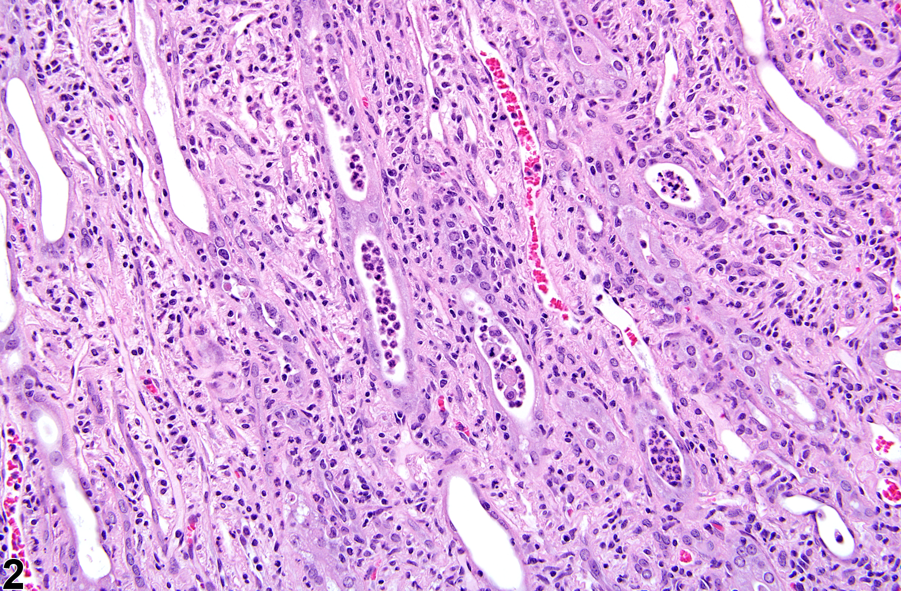 Image of inflammation, acute in the kidney from a female F344/N rat in a chronic study