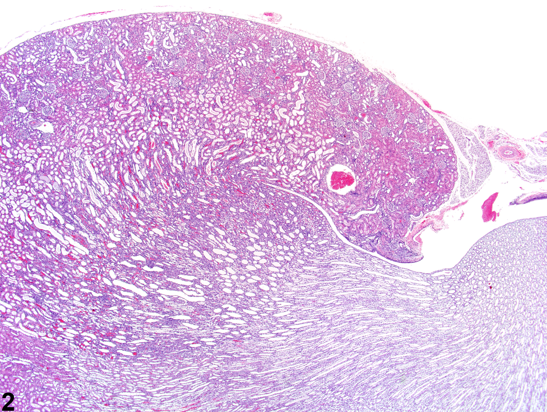 Image of nephropathy, obstructive in the kidney from a female Harlan Sprague-Dawley rat in a subchronic study