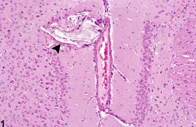 Brain Epidermoid Cyst Nonneoplastic Lesion Atlas